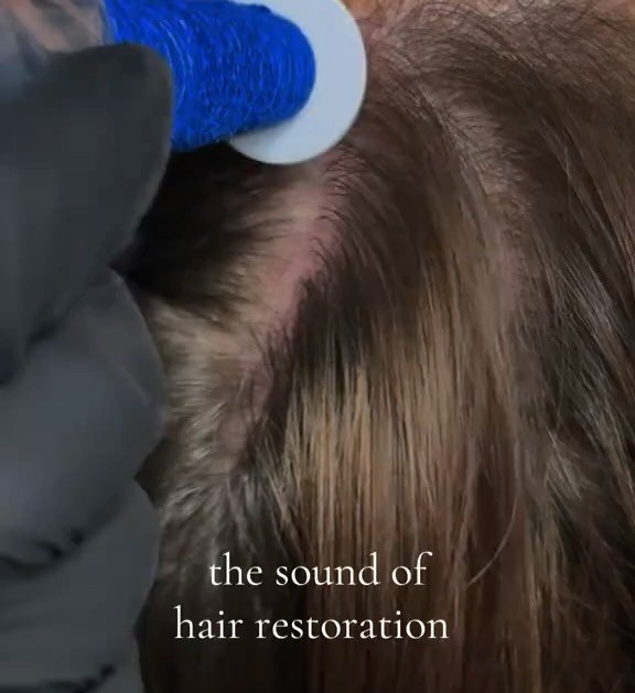 Discover a solution for thinning hair! 🌟 Dive into your new go-to treatment: Procell Microchanneling. 

This innovative procedure revitalizes inactive follicles and enhances your natural hair growth journey ( with ZERO down time) 🌿✨ 

Experience th