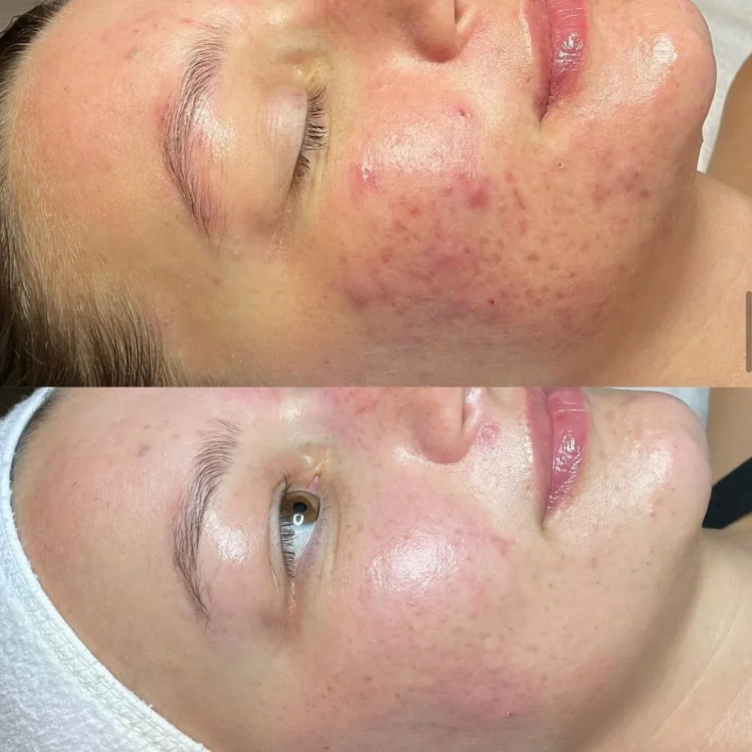 Before and after images of a woman's face showing improvement in skin condition with redness, pimples, and uneven texture reduced.