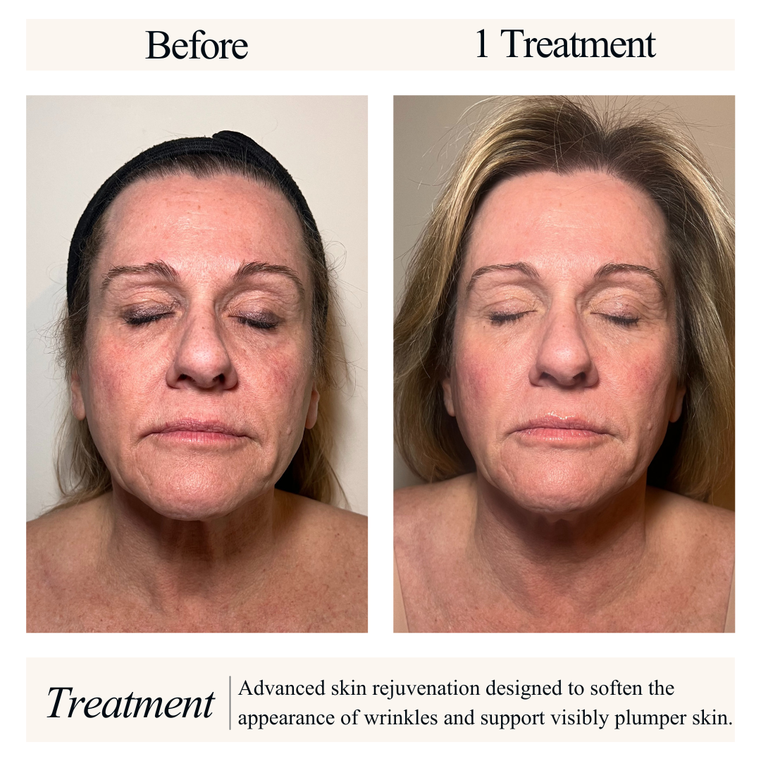 Side-by-side comparison of a woman's face before and after skin rejuvenation treatment, showing reduced wrinkles and smoother skin.
