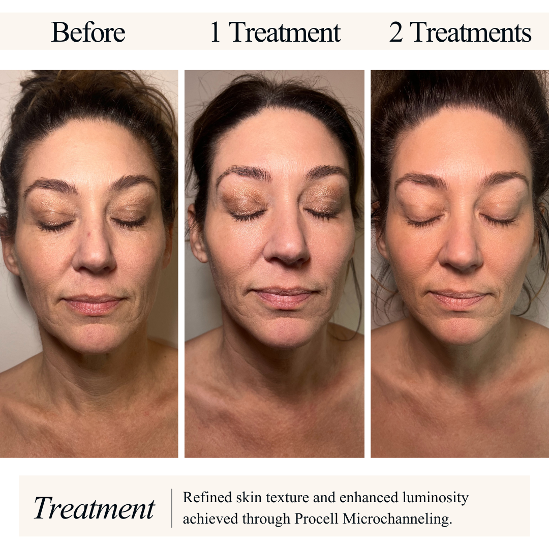 Progress photos of a woman's face showing improvements from three skin treatments. The 'before' photo shows her skin with uneven texture and blemishes. The middle photo, labeled '1 Treatment,' displays some smoothing of skin texture. The '2 Treatments' photo shows further refinement, with smoother and more luminous skin. Text at the bottom notes that refined skin texture and enhanced luminosity are achieved through Procell Microchanneling.