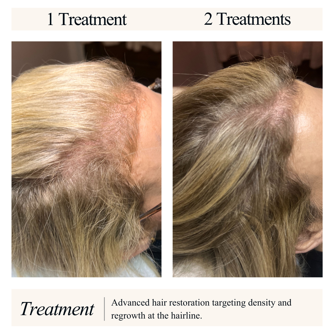 Comparison of hair density before and after advanced hair restoration treatment showing increased hair growth and density at the hairline.
