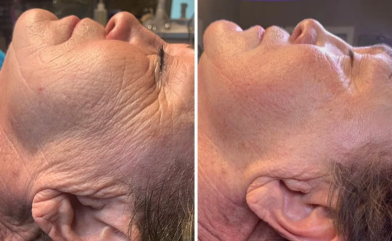 Side-by-side comparison of a woman’s face and ear showing a before and after of skin rejuvenation or cosmetic treatment. The left side features wrinkled and sagging skin, while the right side shows smoother, tighter skin.
