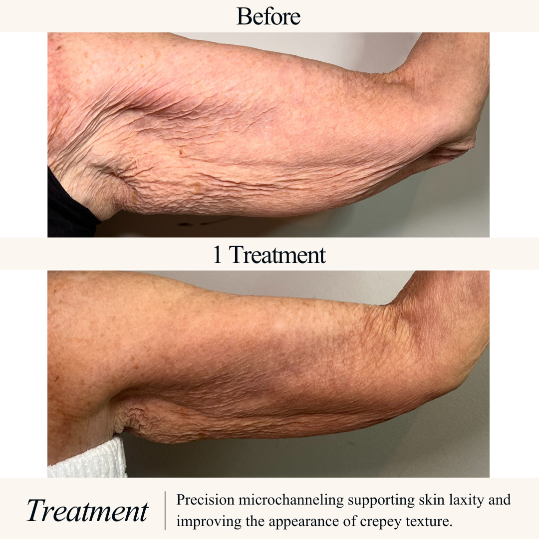 Before and after images of an arm showing improved skin texture after microchanneling treatment, which supports skin laxity and reduces crepey appearance.