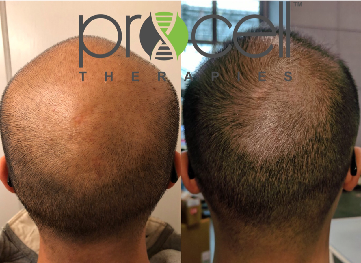 Comparison of a person's scalp before and after hair therapy treatment, showing increased hair density and growth on the right.