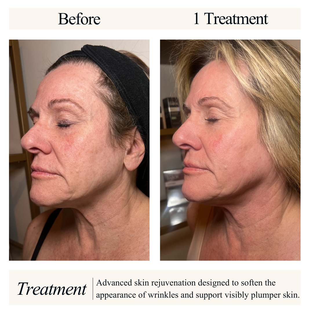 Side-by-side comparison of a woman's face before and after skin rejuvenation treatment; before image shows wrinkles and uneven skin texture, after image shows smoother, plumper skin with fewer wrinkles.