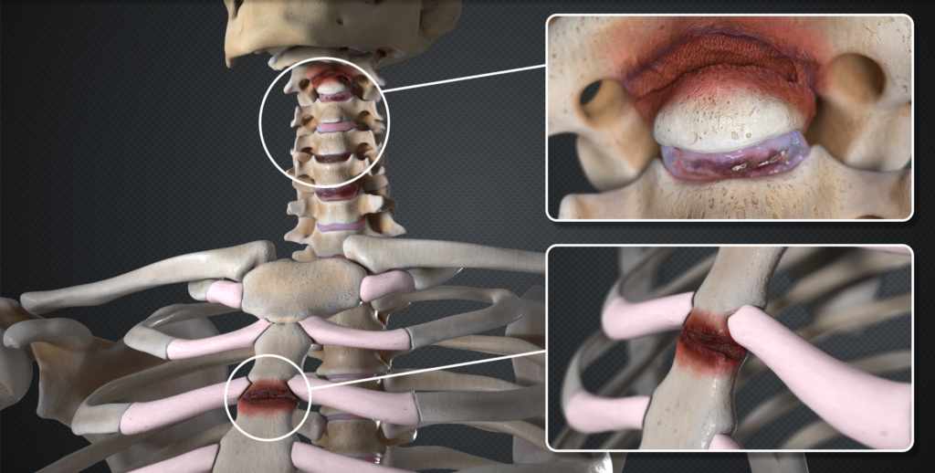 A human skeleton model showing three areas of injury or damage, including a close-up of the cervical spine, a close-up of the thoracic vertebra, and an inner view of the throat or mouth.