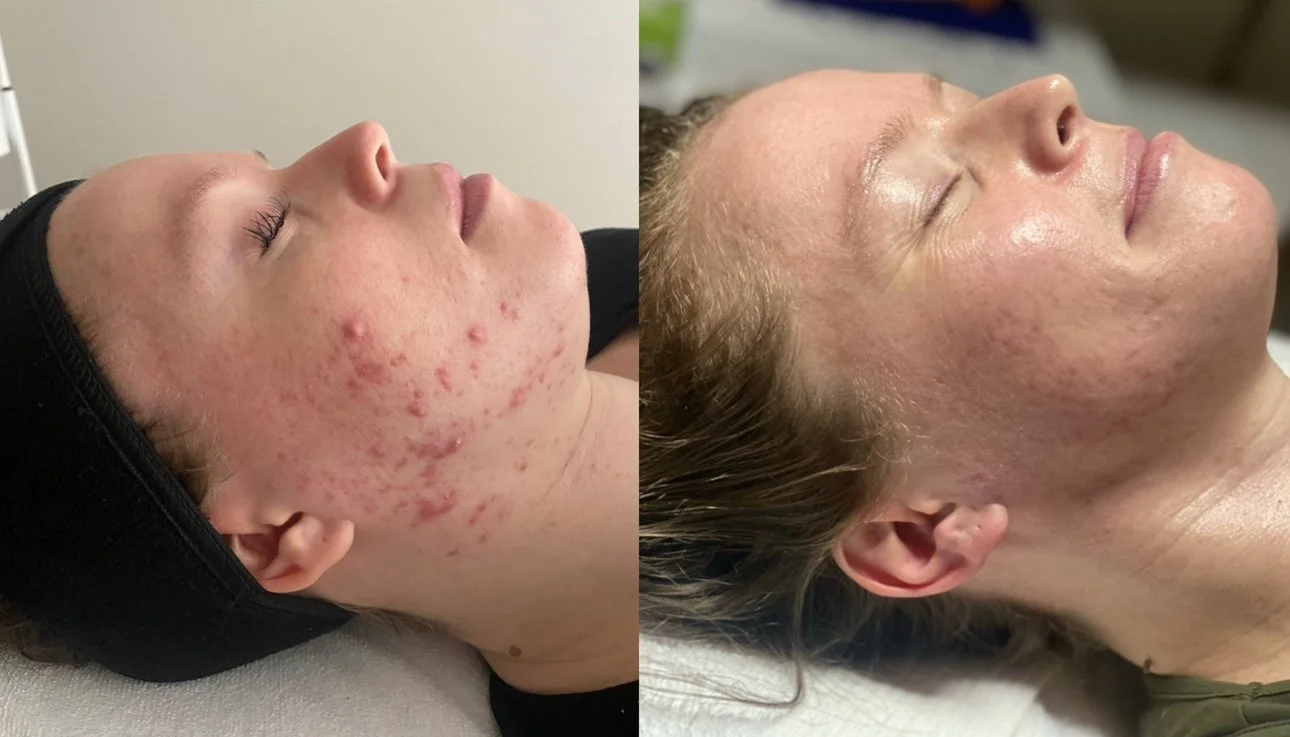 Side-by-side comparison of a woman's face before and after skincare treatment, showing significant reduction in acne and skin redness.