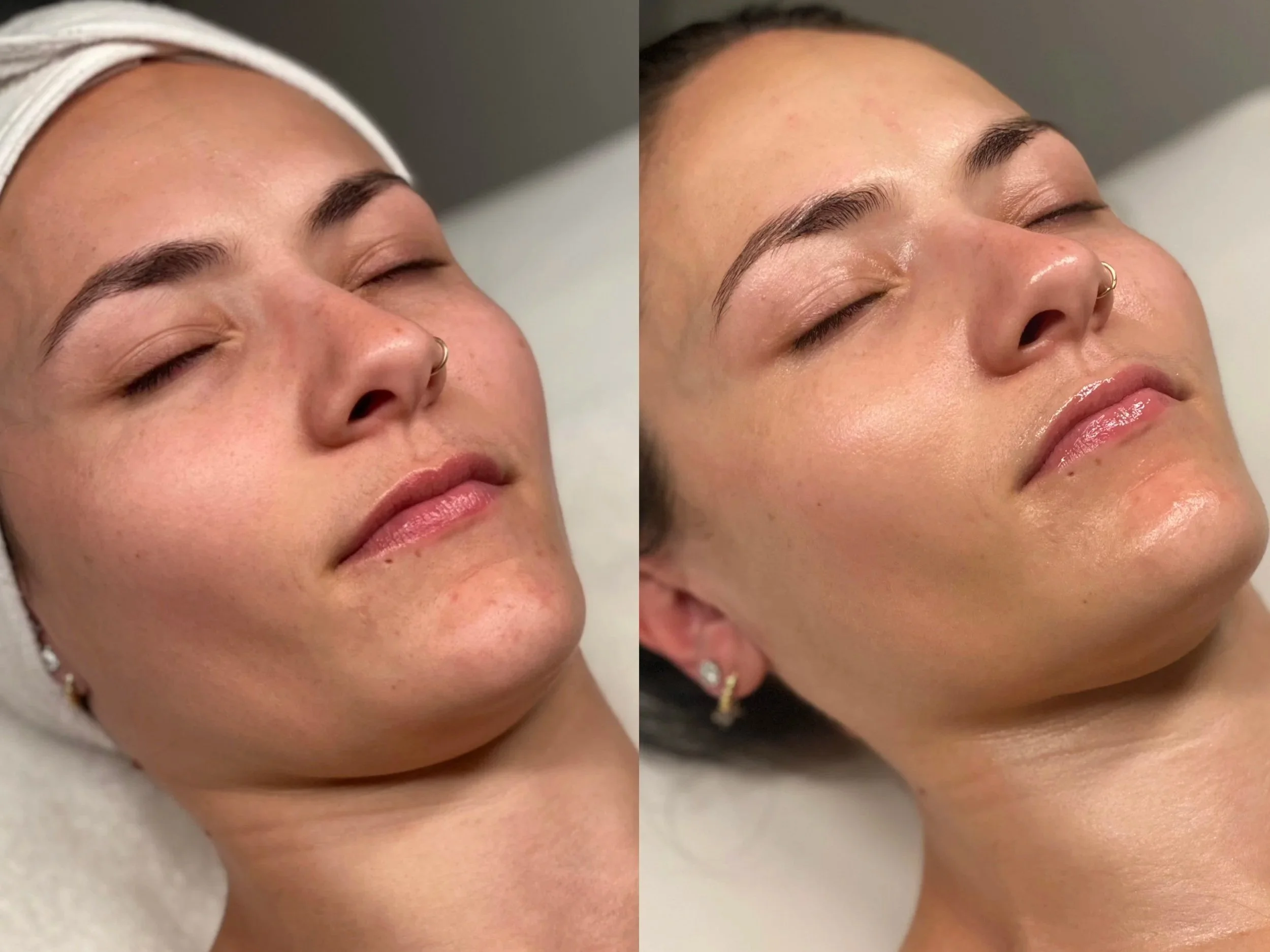 A picture of a woman's face before and after Gua Sha Lymphatic Sculpting, showing reduced swelling under her chin and jawlinne.