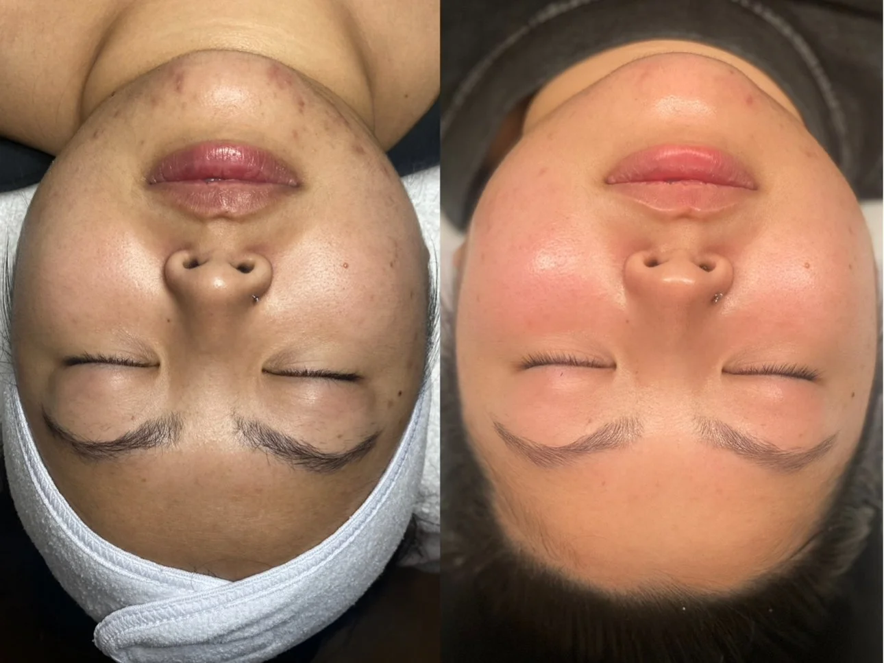 Before + after a series of microdermabrasion treatments, brightening peels, and o2 Tox Peels reveals reduced hyperpigmentation, brighter and healthier skin. 