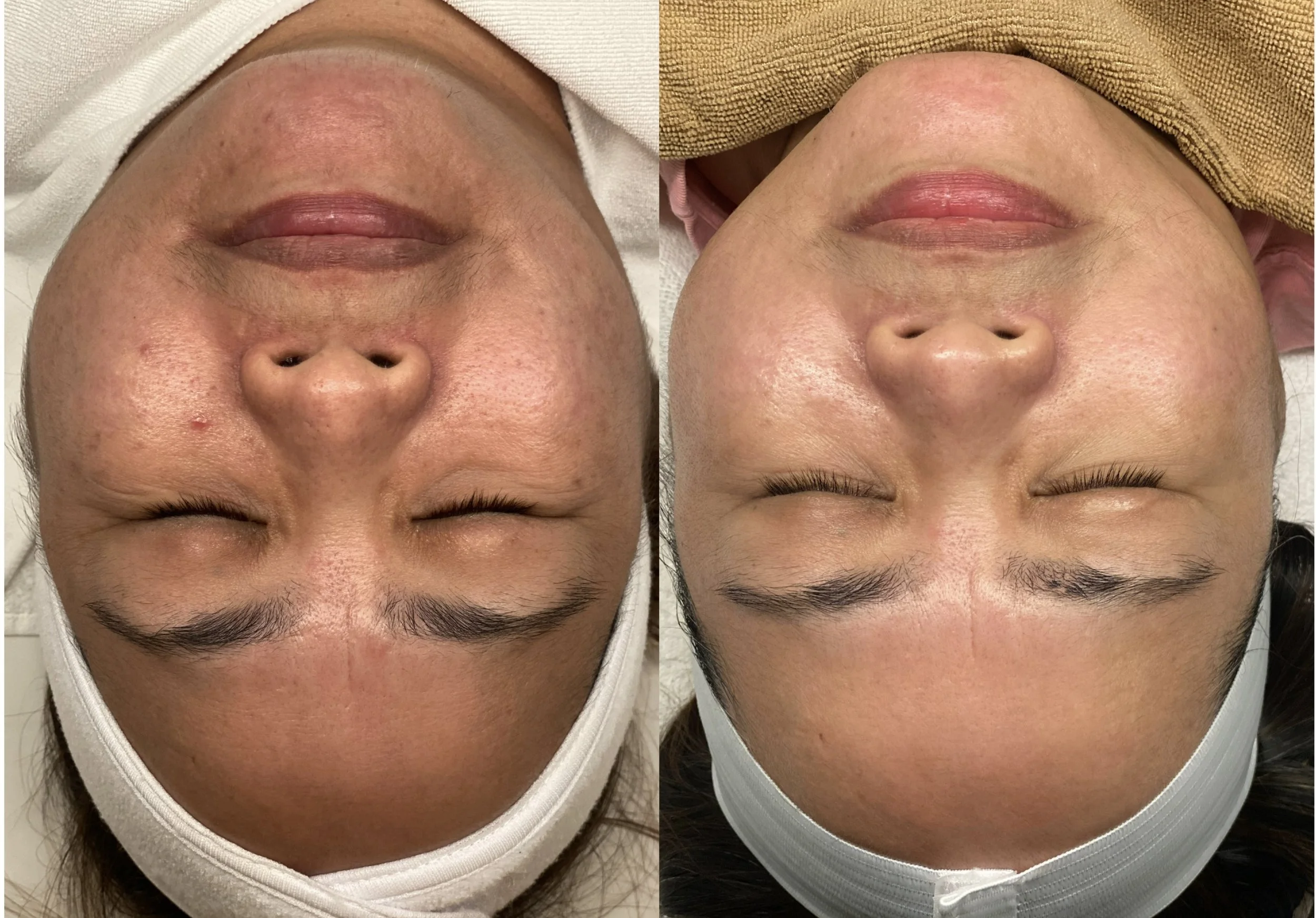 Before + after a series of "liquid microneedling" an all-natural alternative to microneedling that uses spicules derived from sea sponge that target scarring, uneven skin tone, fine lines and wrinkles, and loss of elasticity. 