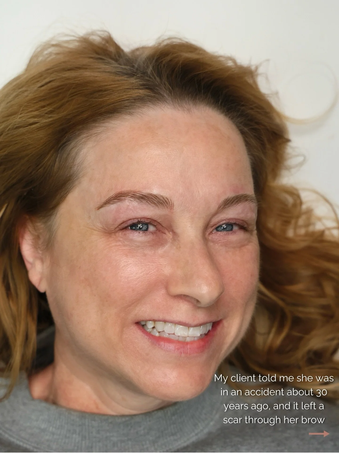 Every brow has a different history.
This work focused on scar tissue, restoring an arch, and creating balance❤️

&mdash;&mdash;&mdash;&mdash;&mdash;&mdash;&mdash;&mdash;&mdash;&mdash;&mdash;&mdash;&mdash;&mdash;&mdash;&mdash;&mdash;&mdash;&mdash;&mda