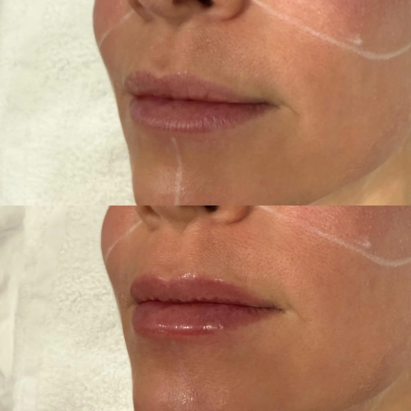 Pucker up for LipLASE! 

&bull; Plump, smooth, no needles&mdash;just LipLase magic ✨💋
&bull; Natural volume, zero fillers. Hello LipLase glow 💄
&bull; Soft, hydrated, and subtly fuller&mdash;LipLase did that 💫
&bull; Your lips, but better. Thanks 