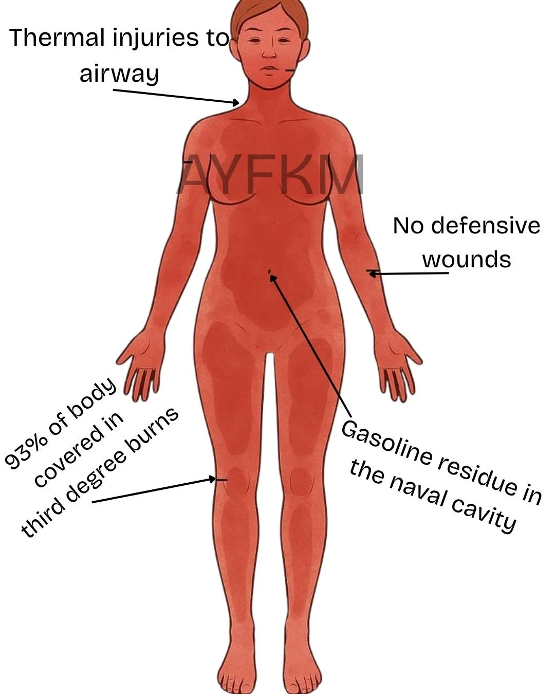 Illustrated summary of Jessica Chambers’ autopsy findings, highlighting 93% third-degree burns, thermal airway injuries, absence of defensive wounds, and gasoline residue in nasal cavity and throat—graphic true crime visual for forensic analysis.