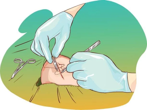 A surgical procedure being performed, with hands in gloves using surgical tools on a patient's skin, with a pair of scissors nearby.