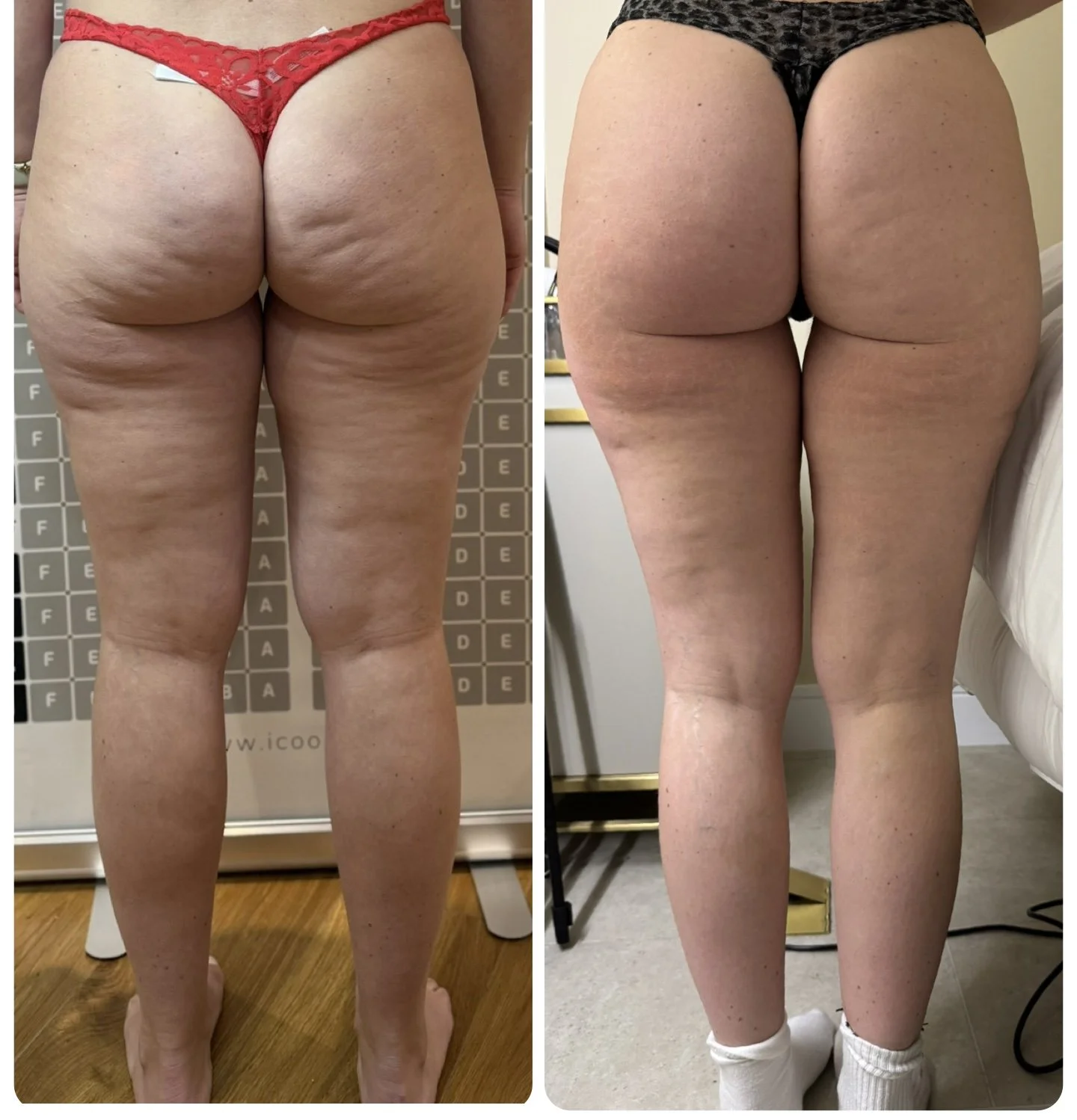 ICOONE - Anti Cellulite Course