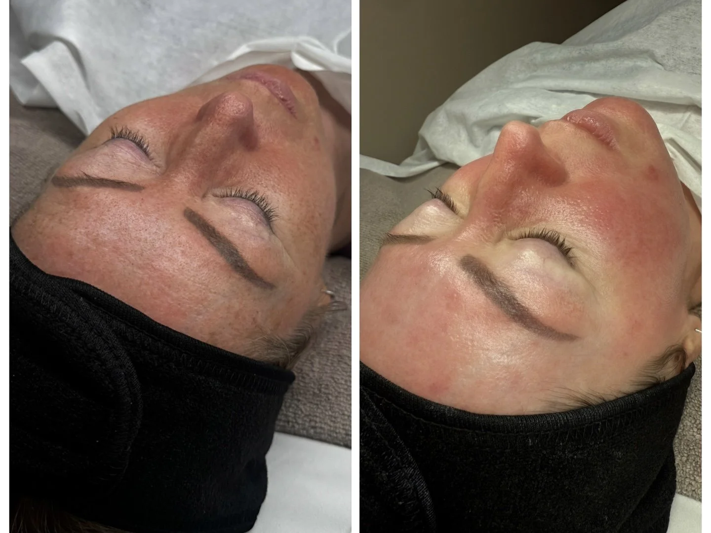 Hydra Facial - Before / After
