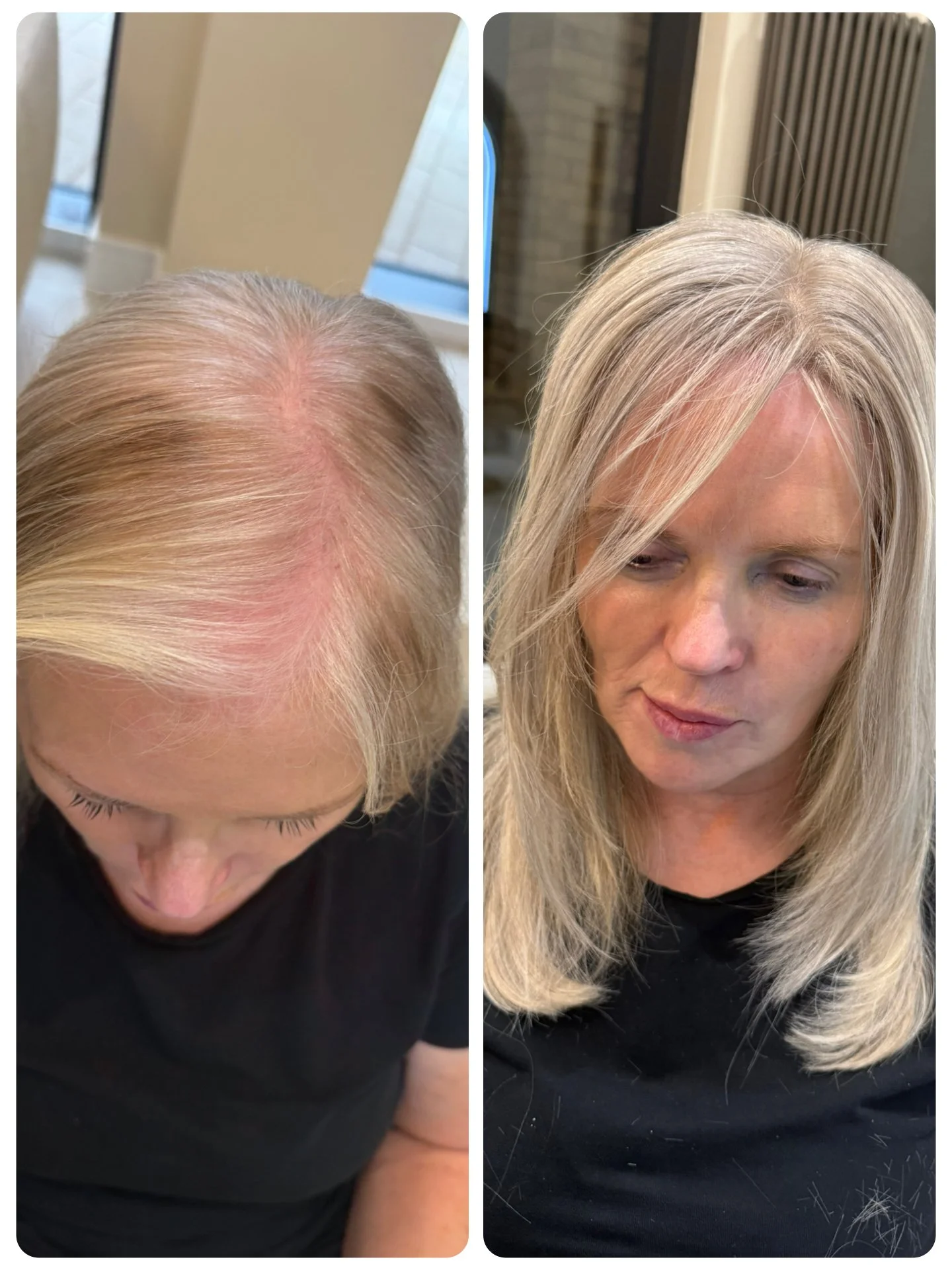 Hair Loss Mesh Free System