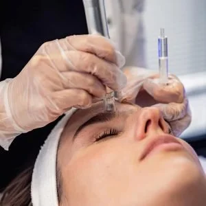 Microneedling for skin improvement (4 x 1 hour treatments)