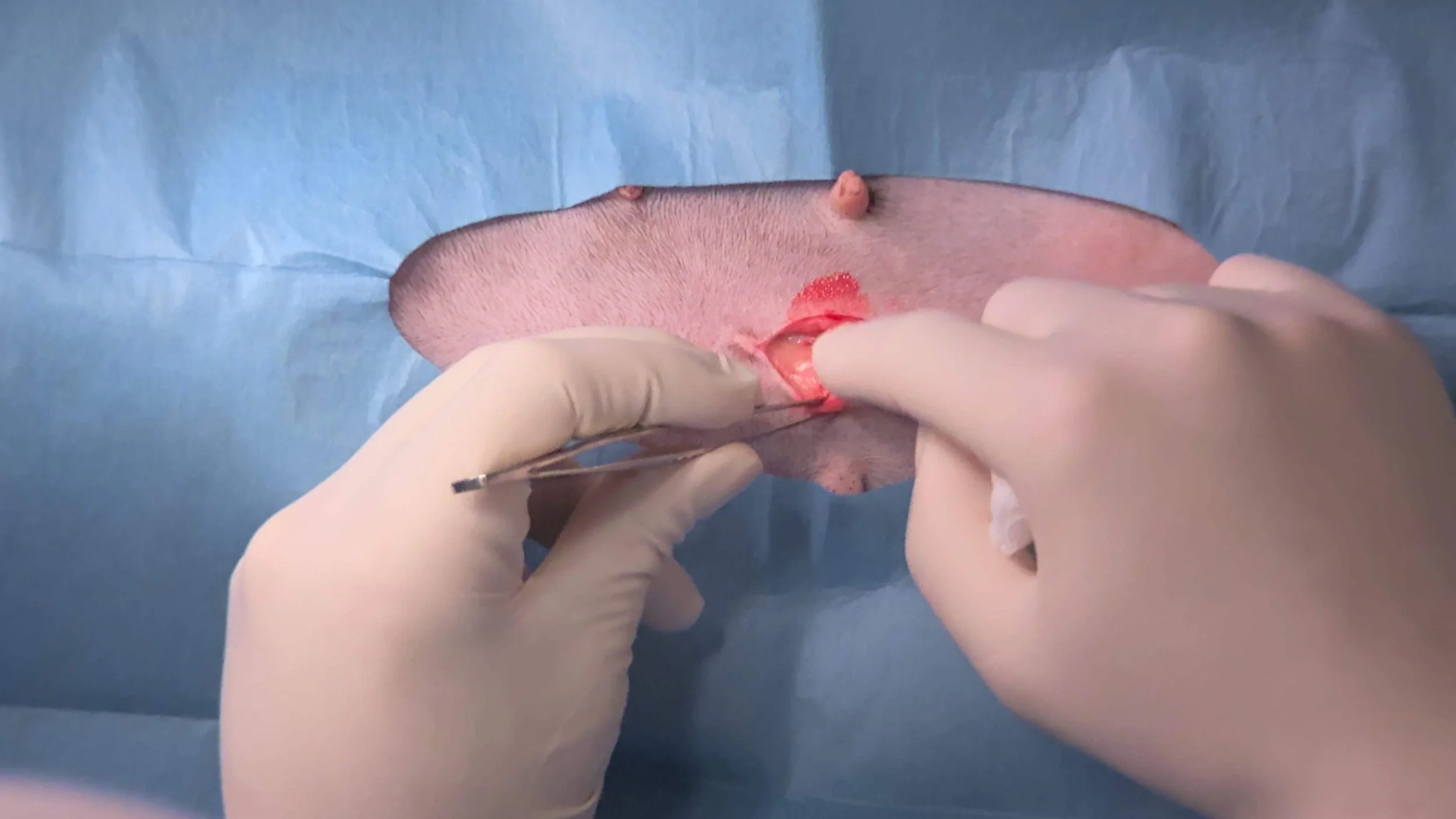 A healthcare professional in gloves performs a small surgical procedure on a male patient's face, using surgical tools.