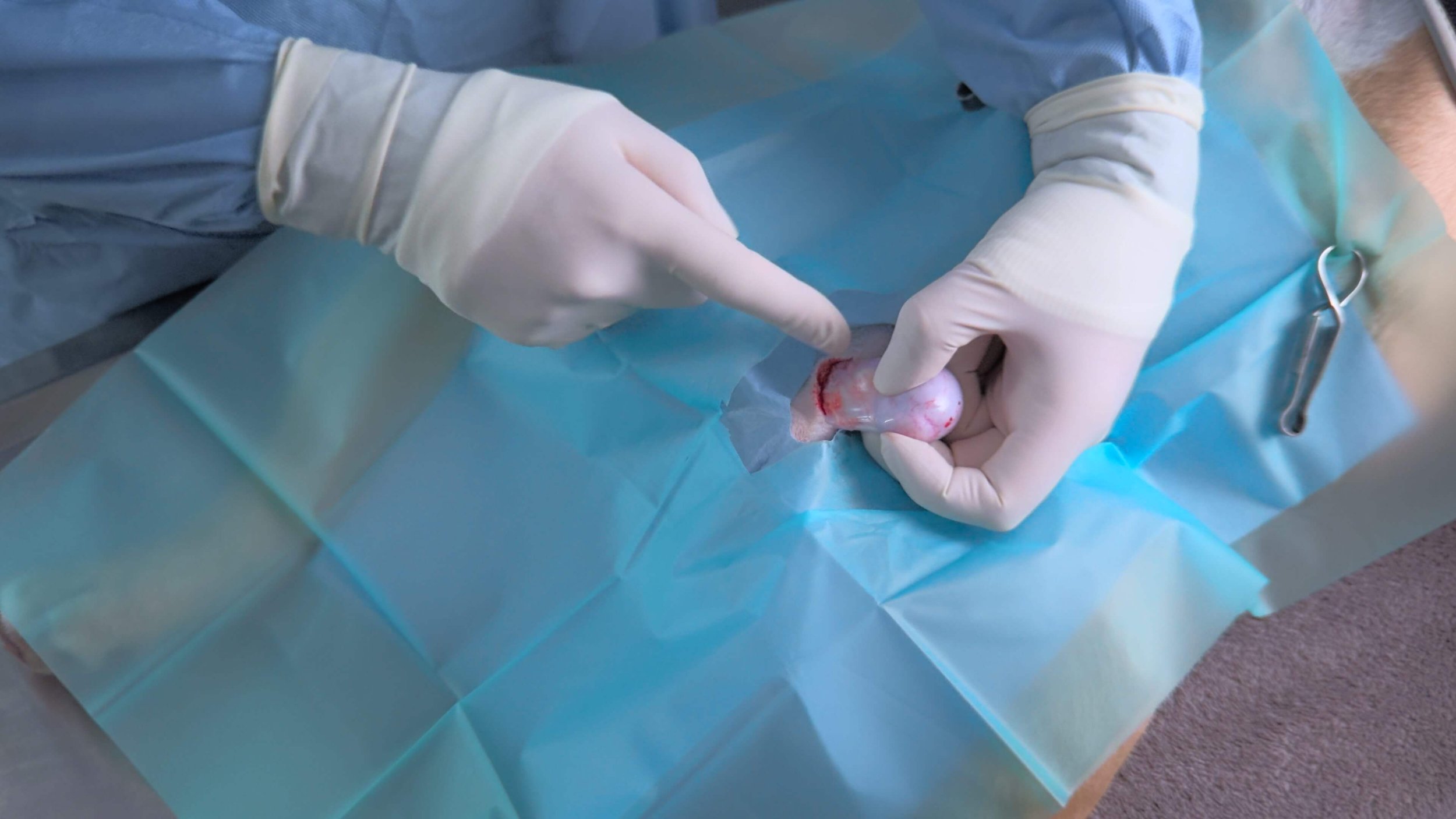 A medical professional wearing gloves is inserting a small surgical instrument into a newborn baby's umbilical cord stump, which is on a sterile blue drape.