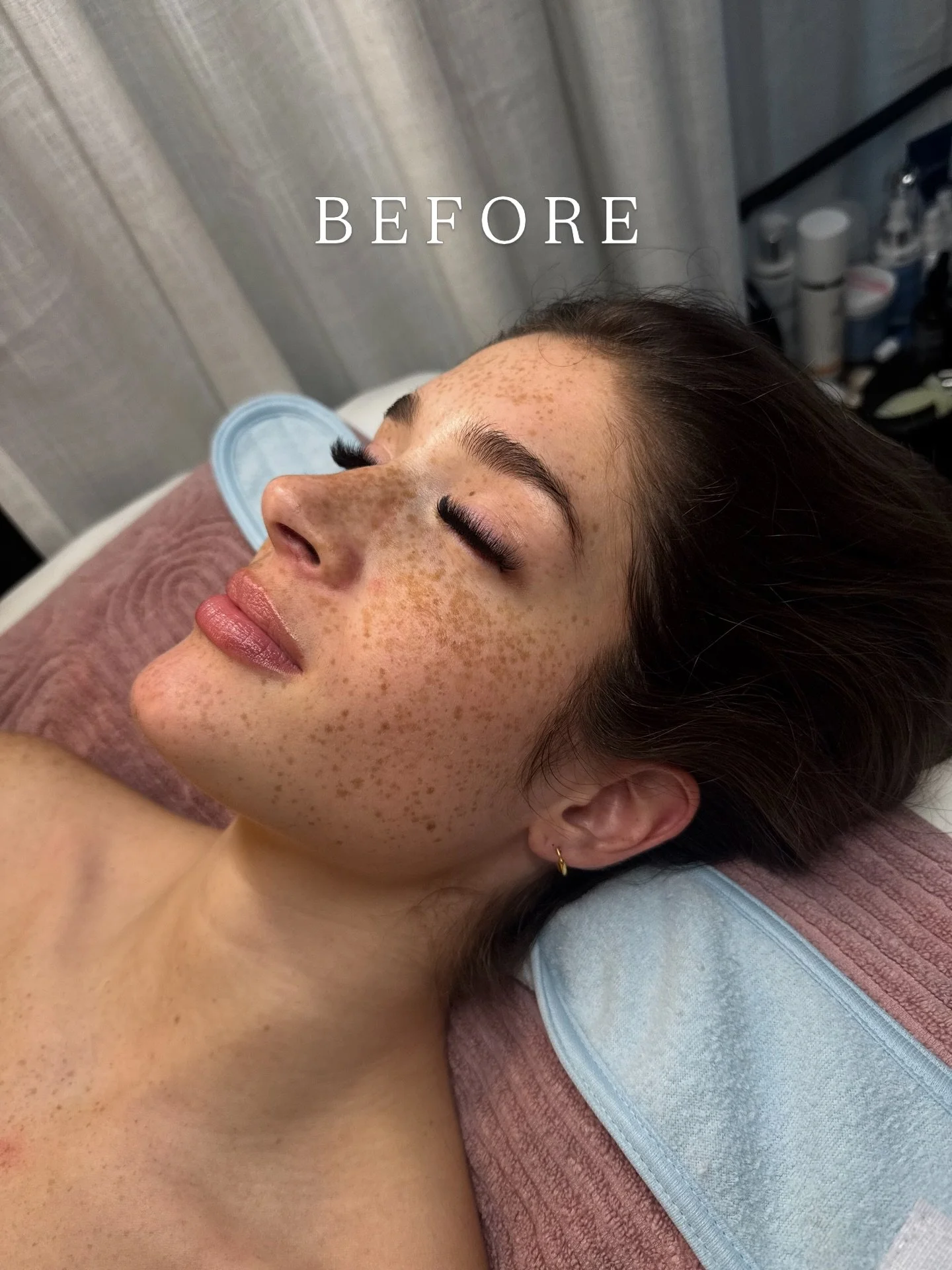 swipe for a before and after on this beauty 🤩✨

her glow was toooooo good not to share

#dfwesthetician #facial #dfwfacial #dfwskincare #grapevine
