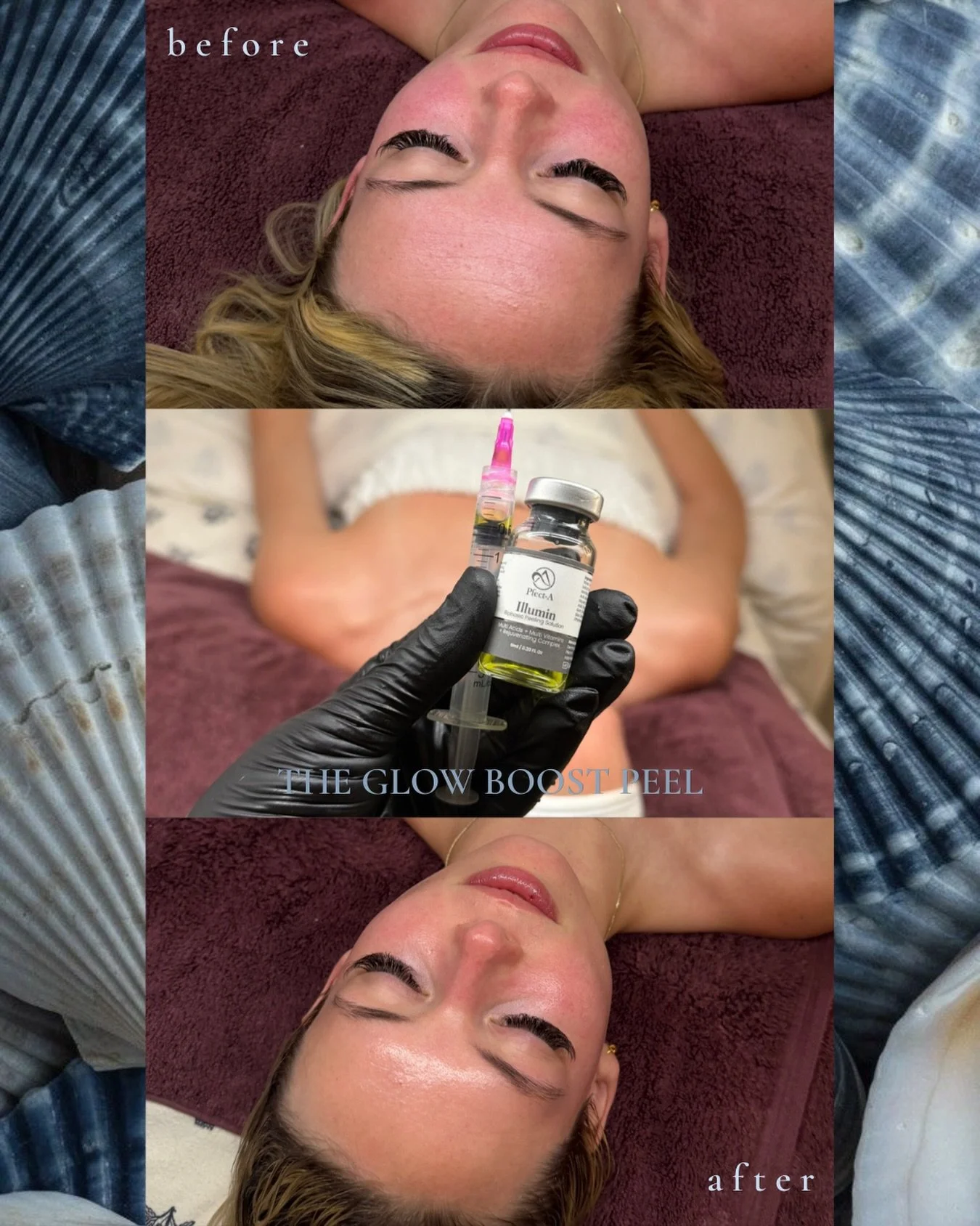 proof that you don&rsquo;t always need aggressive treatments to see a difference ✨

two glow boost peels + customized home care helped calm visible redness, smooth texture, and leave her skin looking brighter and healthier overall.

this treatment is
