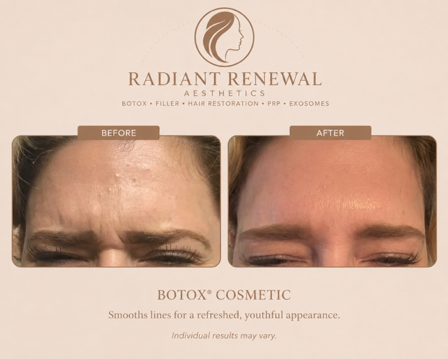 Botox treatment to soften frown lines and forehead and crow's feet in Ocean Springs Mississippi.