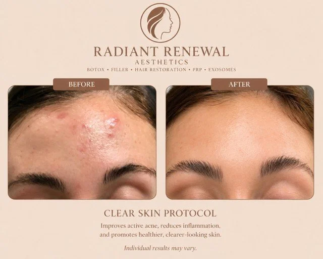Intradermal Botox treatment to reduce oil production and improve skin texture in Ocean Springs, Mississippi.
