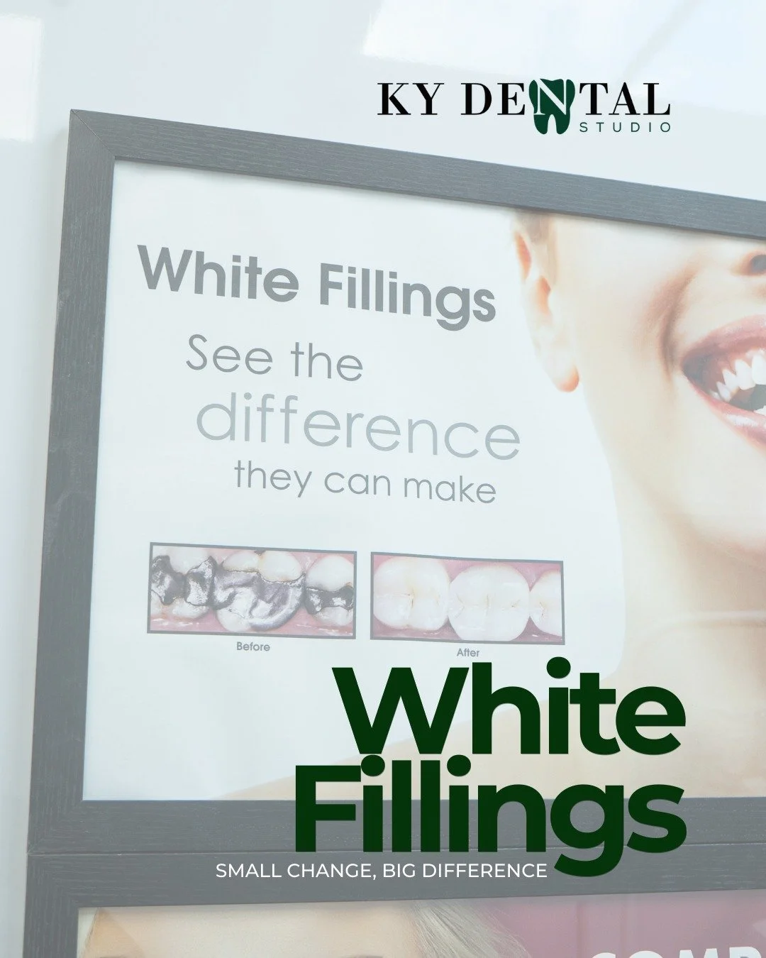 A natural-looking result can make all the difference.

White fillings are a simple way to restore teeth while maintaining a more seamless, confident smile. This treatment is ideal for patients looking for a practical solution that also supports aesth