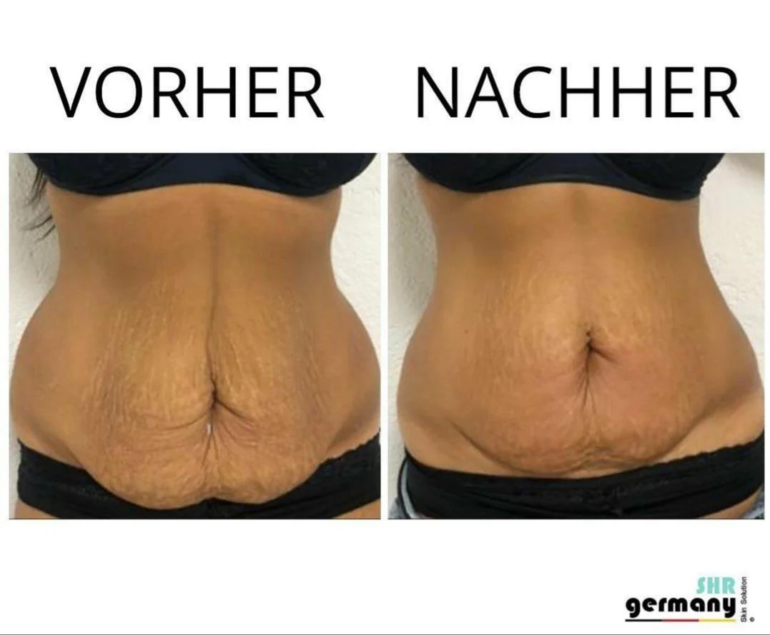 Side-by-side comparison of a person's abdomen before and after a treatment, labeled 'Vorher' (before) and 'Nachher' (after), showing decreased skin sagging and improved skin texture.
