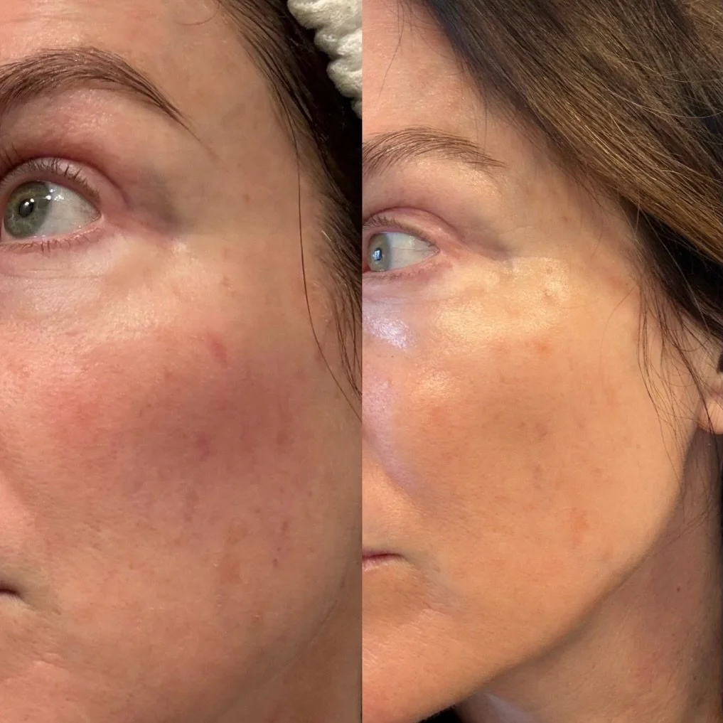Six weeks. Six treatments. Real progress. ✨

This photo shows what consistent cool peels can do for hyperpigmentation. Instead of one aggressive treatment, we focused on controlled, repetitive resurfacing to gently lift pigment and brighten overall t
