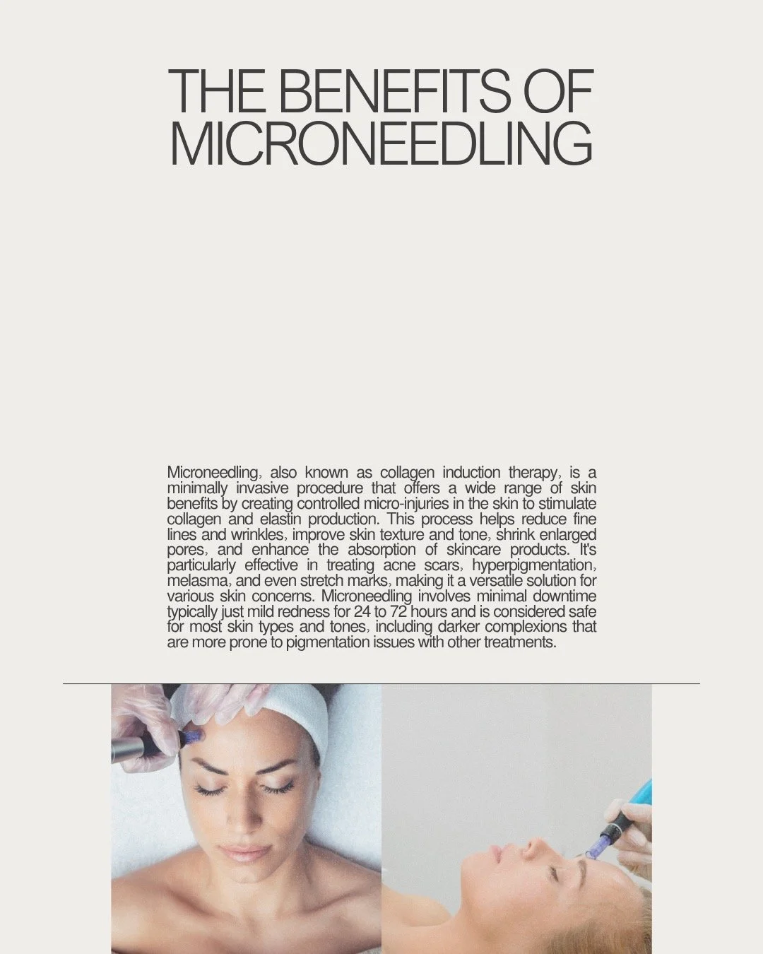 #Microneedling#MicroneedlingTreatment#SkinRejuvenation#CollagenInductionTherapy#HealthySkin#GlowingSkin#SkincareRoutine#BeautyTreatment#SkinCareGoals#CalabasasSkincare#CalabasasBeauty#NomiMedicalStudio#NomiCalabasas#CalabasasFacial#CalabasasMedSpa#LA