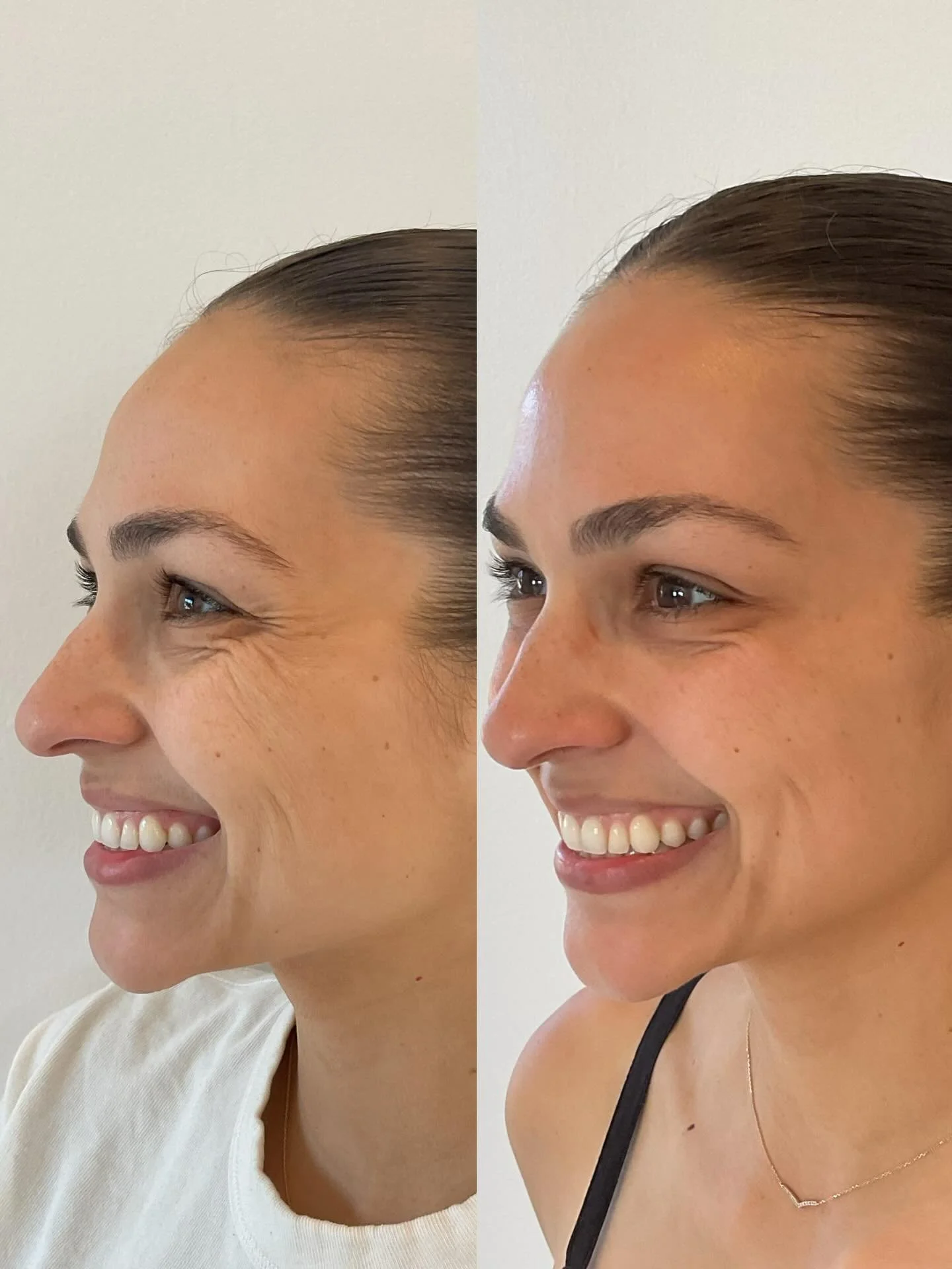 ✨ Crow&rsquo;s Feet Botox for one of the most beautiful souls ✨ 

It was such a joy to treat one of the kindest, hardest-working OBGYN residents I know with a little Botox for her crow&rsquo;s feet. 

She&rsquo;s more than just a talented physician. 