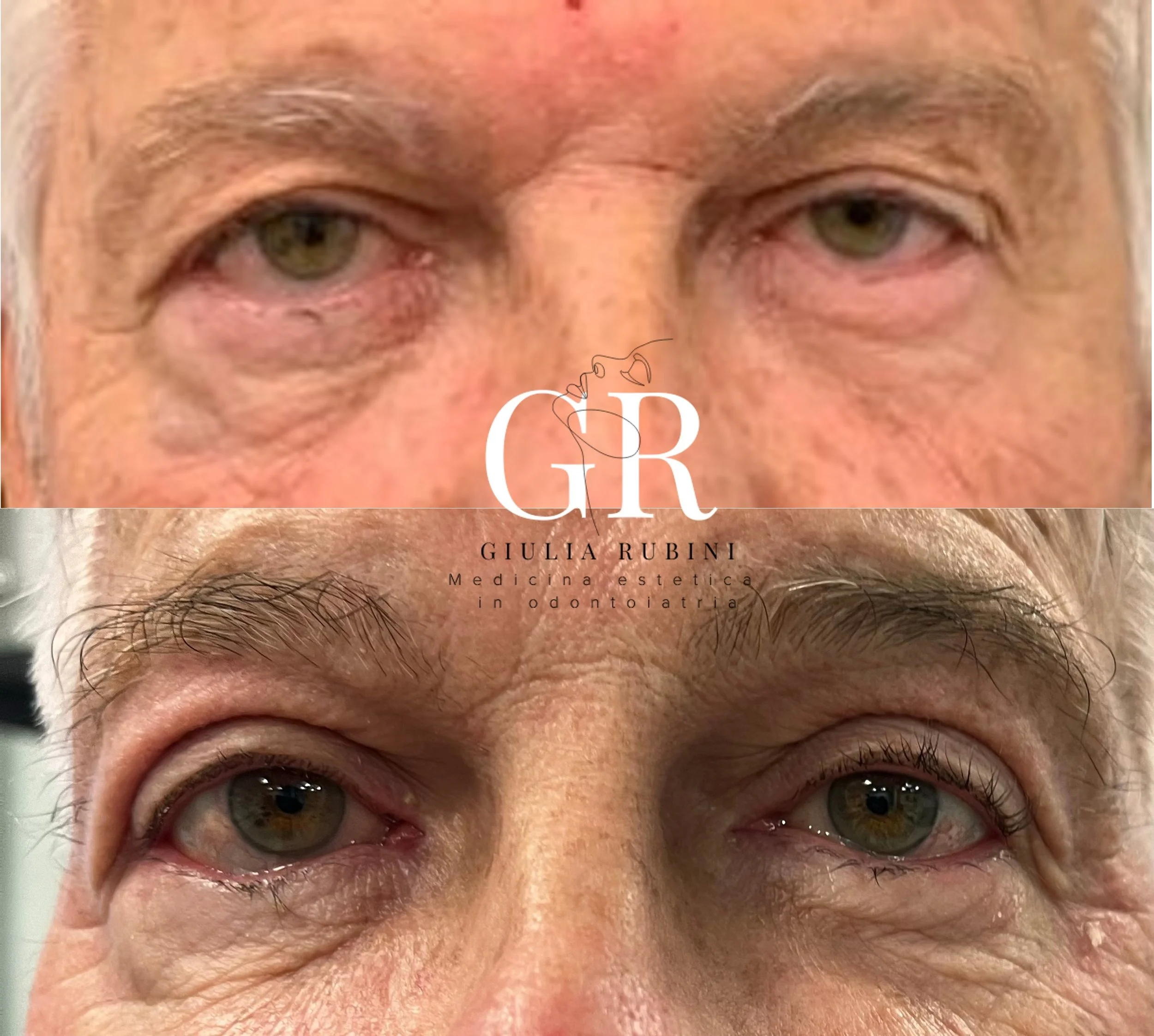 Blefaroplastica non chirurgica con tecnologia Air Plasma, confronto prima e dopo per rassodamento palpebra e apertura dello sguardo senza intervento chirurgico effettuato dalla dott.ssa Giulia Rubini a Rimini