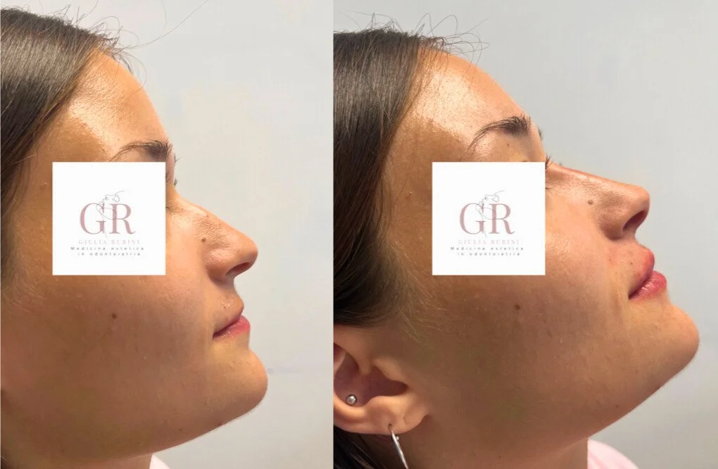 Immagini di un prima e dopo di un trattamento di miglioramento del profilo di una donna che comprende diversi tipi di filler, mostrando il miglioramento dell'armonia del profilo del viso prima e dopo il trattamento.