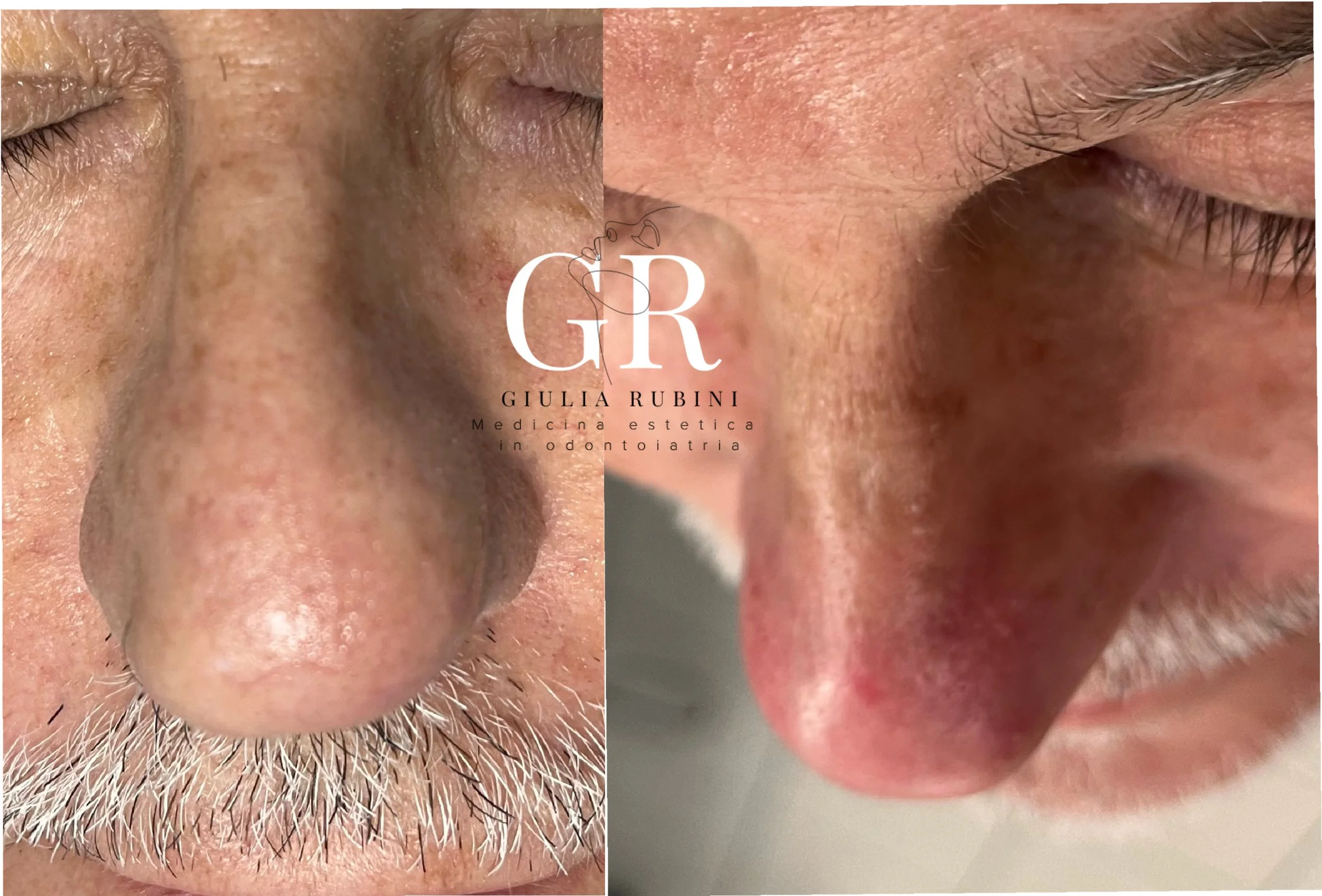 Trattamento Air Plasma per rimodellamento non chirurgico della punta del naso, confronto prima e dopo con miglioramento del profilo e della definizione nasale effettuato dalla dott.ssa Giulia Rubini a Rimini