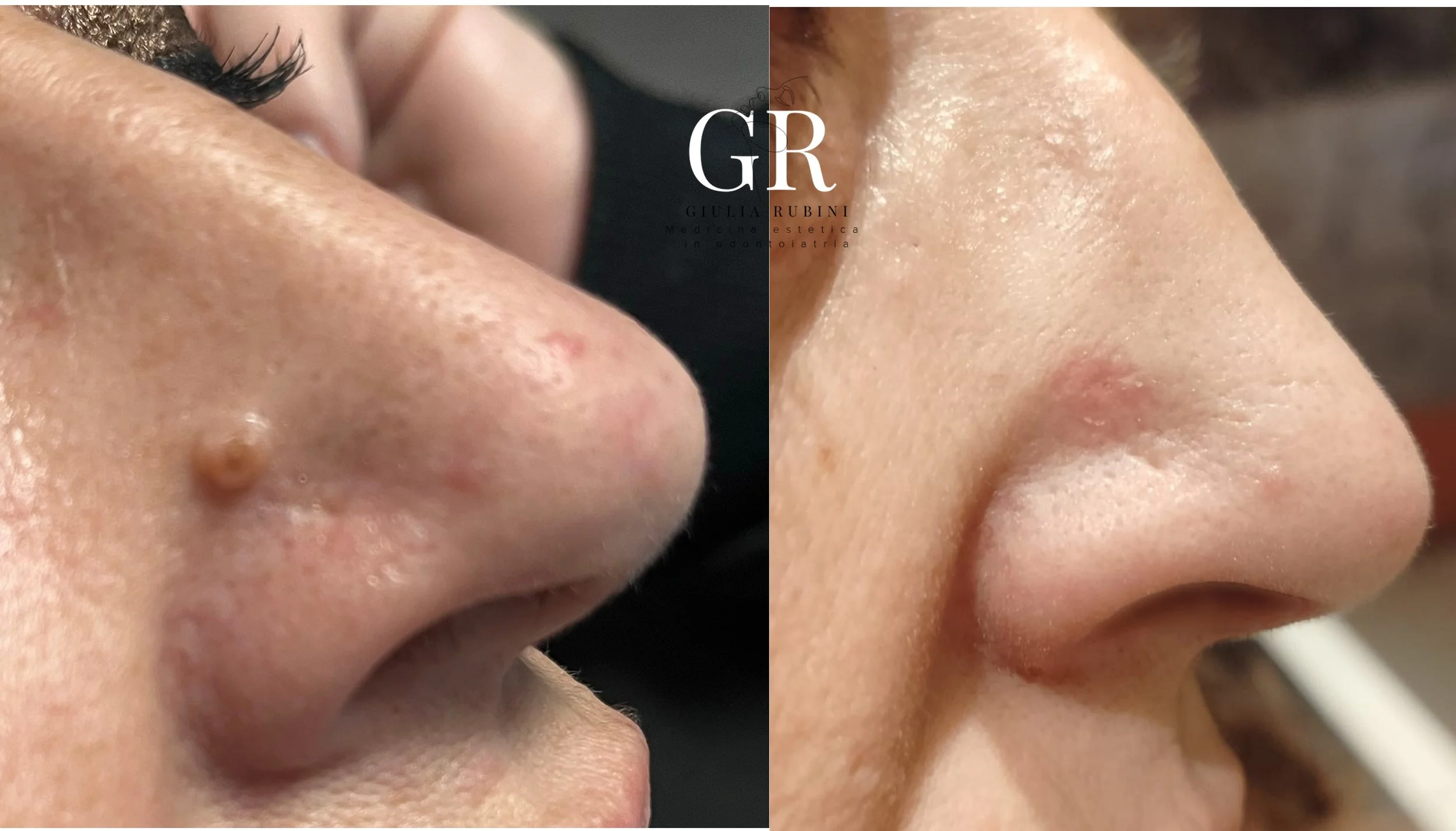 Rimozione di neo benigno con tecnologia Air Plasma, confronto prima e dopo con guarigione cutanea e risultato estetico preciso e non invasivo effettuato dalla dott.ssa Giulia Rubini a Rimini