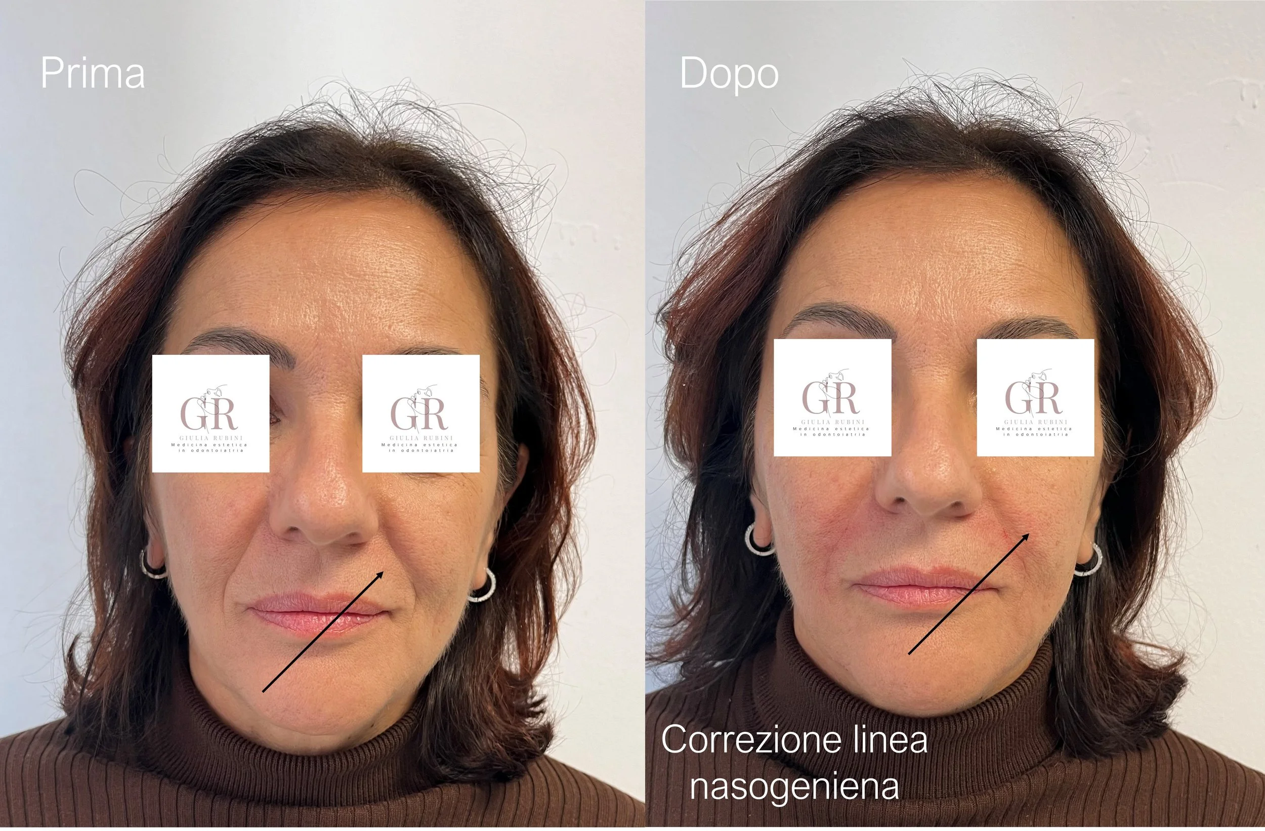 Collage prima e dopo correzione linea nasogeniena con filler, con indicazioni su lato trattato e lato non trattato. La parte trattata mostra un miglioramento delle linee; trattamento effettuato dalla dott.ssa Rubini tra Romagna e Marche.