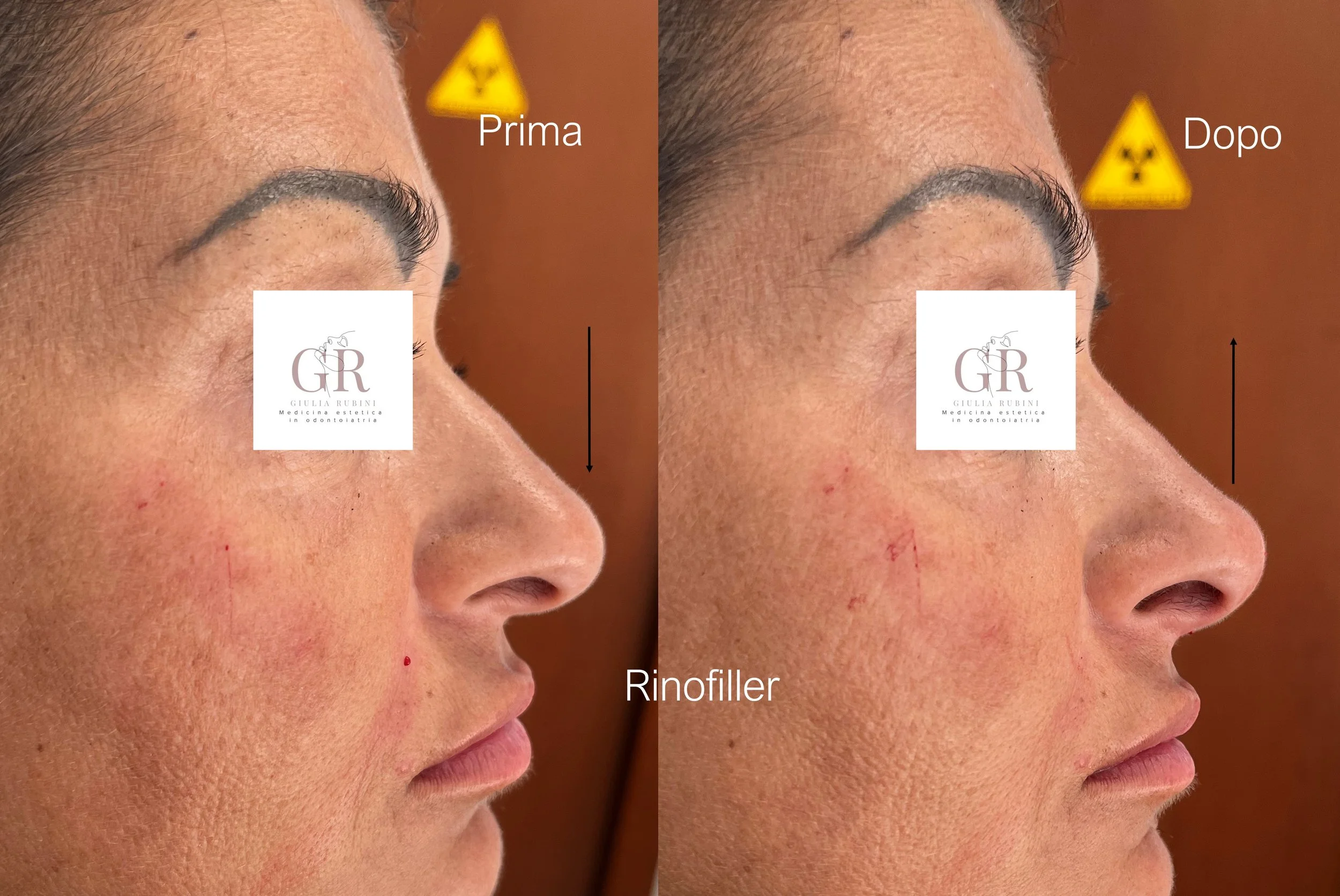 Rinofiller per correggere irregolarità del naso, migliorare il profilo e armonizzare i lineamenti in modo naturale – Dott.ssa Giulia Rubini, medicina estetica Romagna Marche