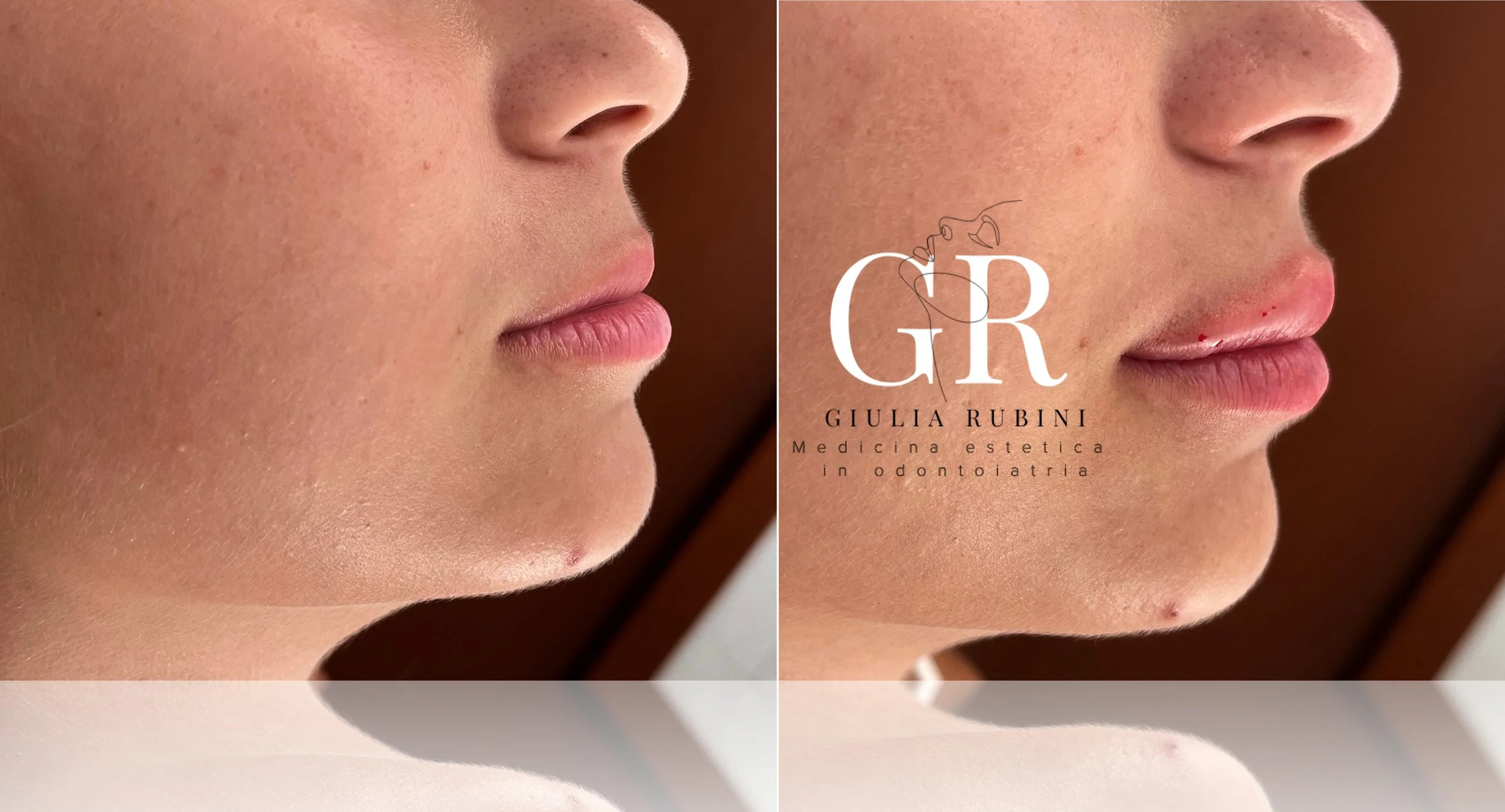 Prima e dopo un trattamento di filler labbra di una ragazza da parte della dott.ssa Giulia Rubini.
