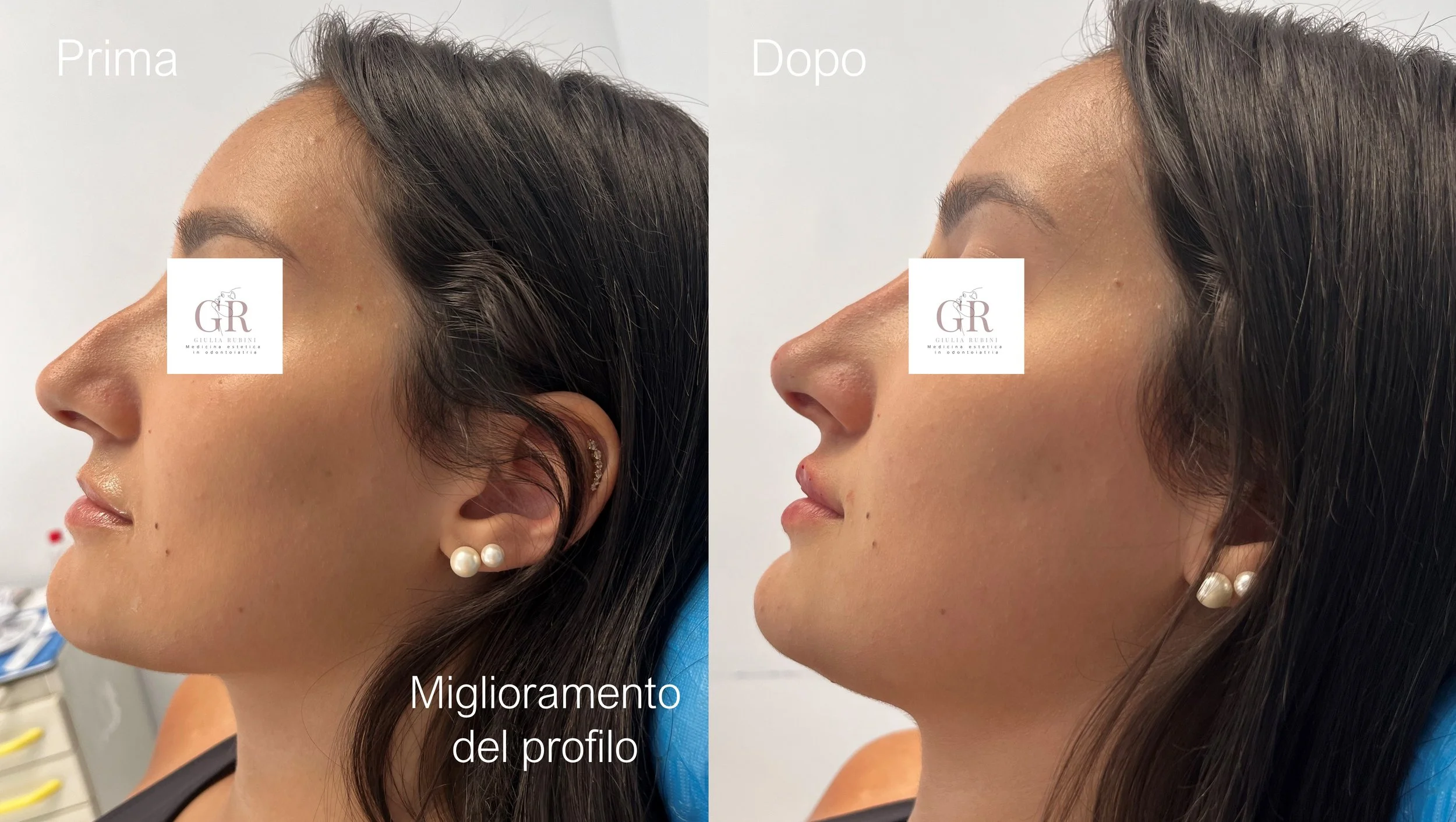 Collage prima e dopo armonizzazione del profilo viso con filler in diverse parti del viso, trattamento estetico naturale con la Dott.ssa Giulia Rubini tra Romagna e Marche.