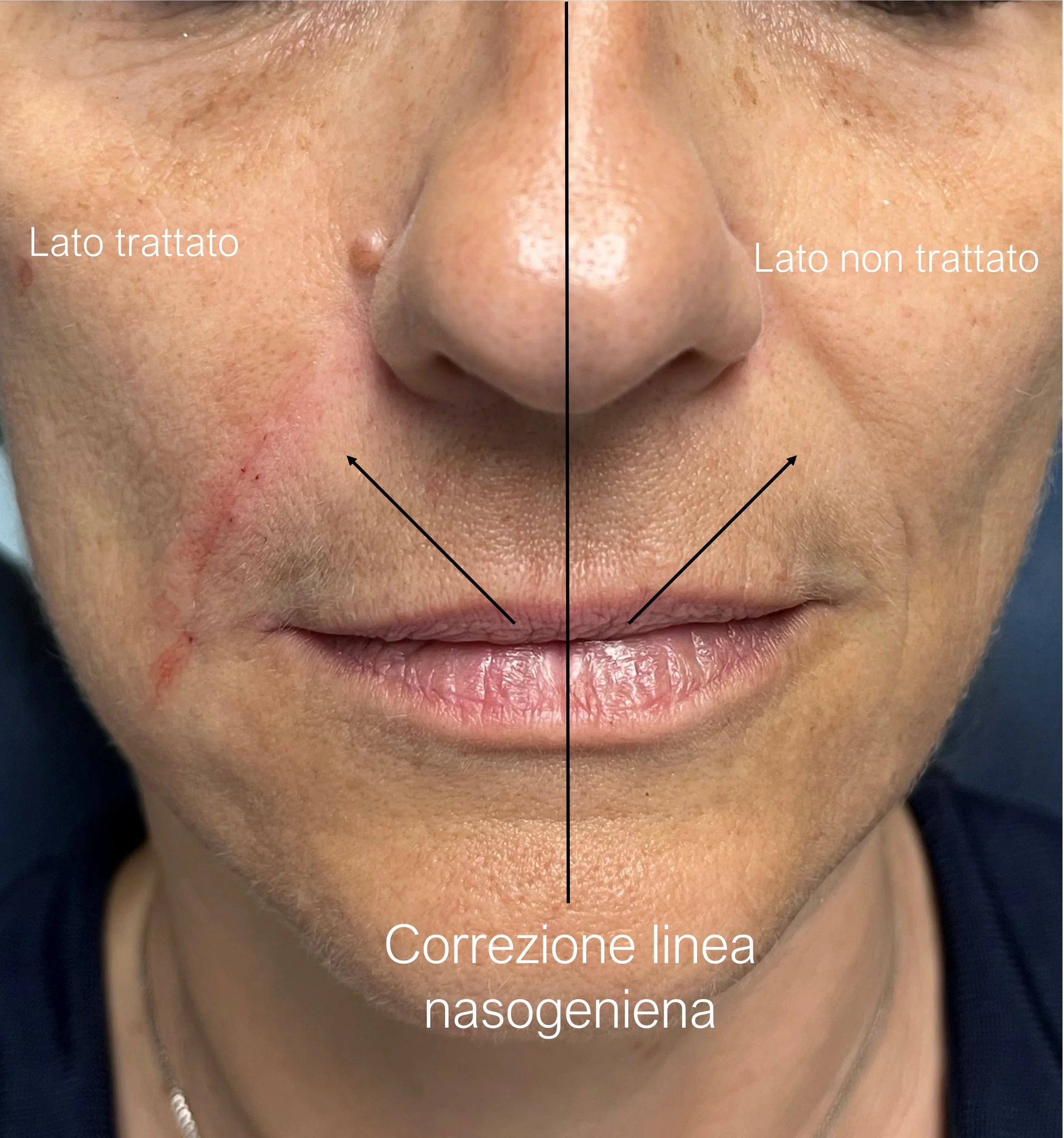 Collage prima e dopo correzione linea nasogeniena con filler, con indicazioni su lato trattato e lato non trattato. La parte trattata mostra un miglioramento delle linee e della pelle mentre l'altro lato mostra i segni di invecchiamento e rughe.