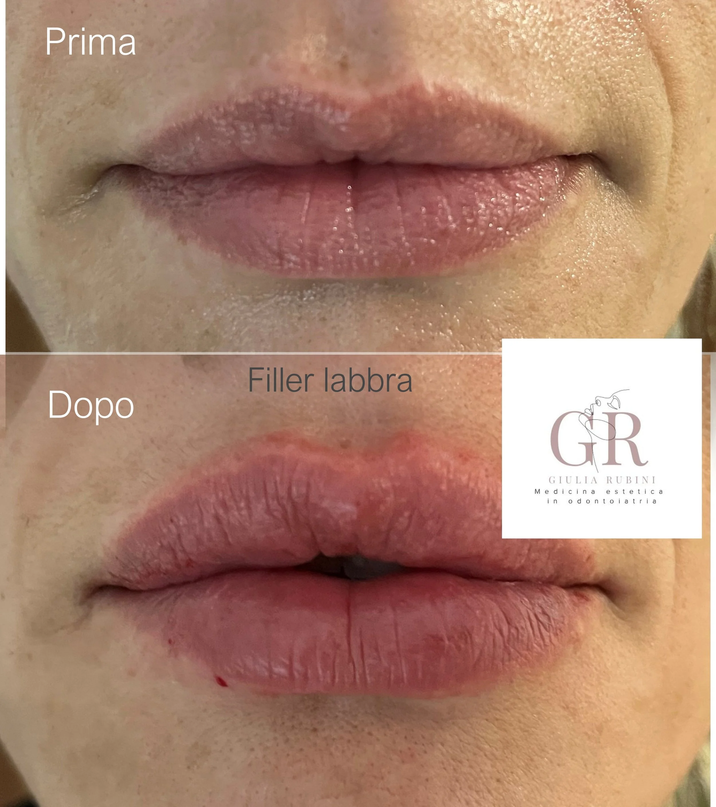 Prima e dopo filler labbra viso armonioso e naturale, trattamento estetico con la Dott.ssa Giulia Rubini in Romagna