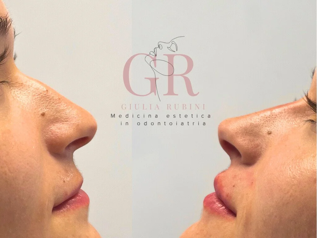 Confronto tra un profilo di un volto femminile prima e dopo un intervento di rinofiller e filler labbra presso uno degli studi odontoiatrici estetici dove opera la dott.ssa Giulia Rubini.