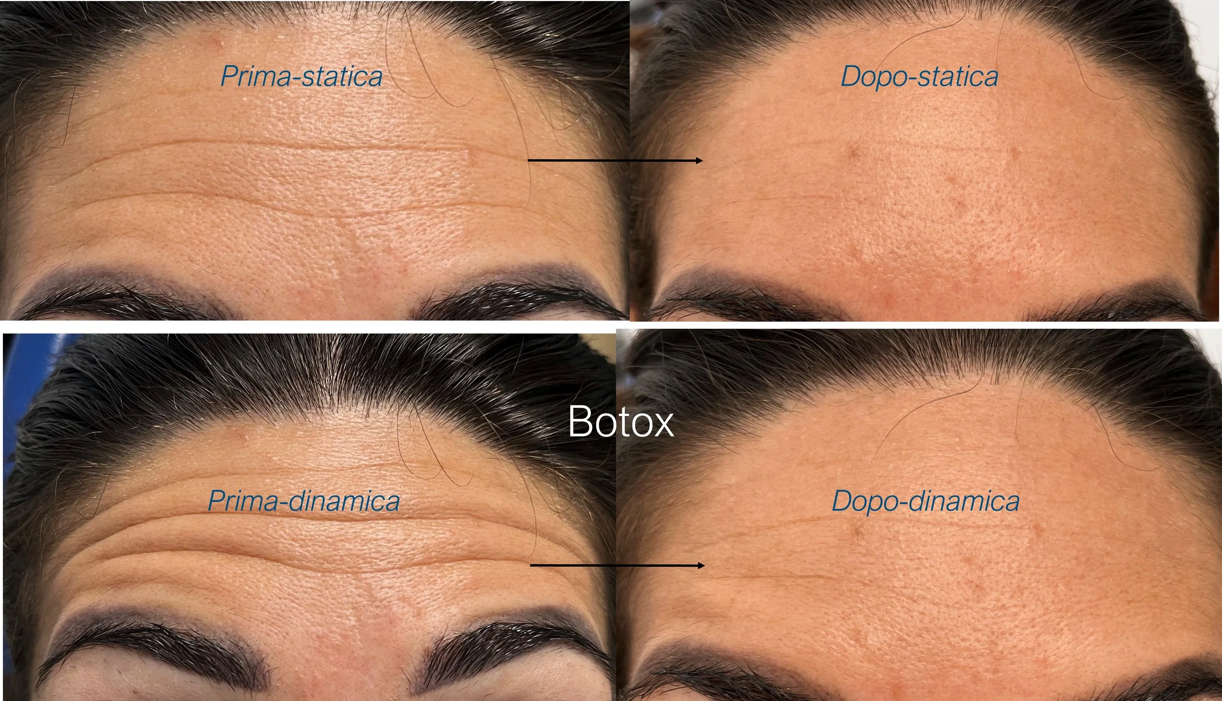 Immagini comparative del volto prima e dopo trattamenti di Botox. La parte superiore mostra la fronte prima e dopo la statica, evidenziando una riduzione delle rughe. La parte inferiore mostra le sopracciglia e la fronte prima e dopo la dinamica, con una diminuzione delle linee di espressione.