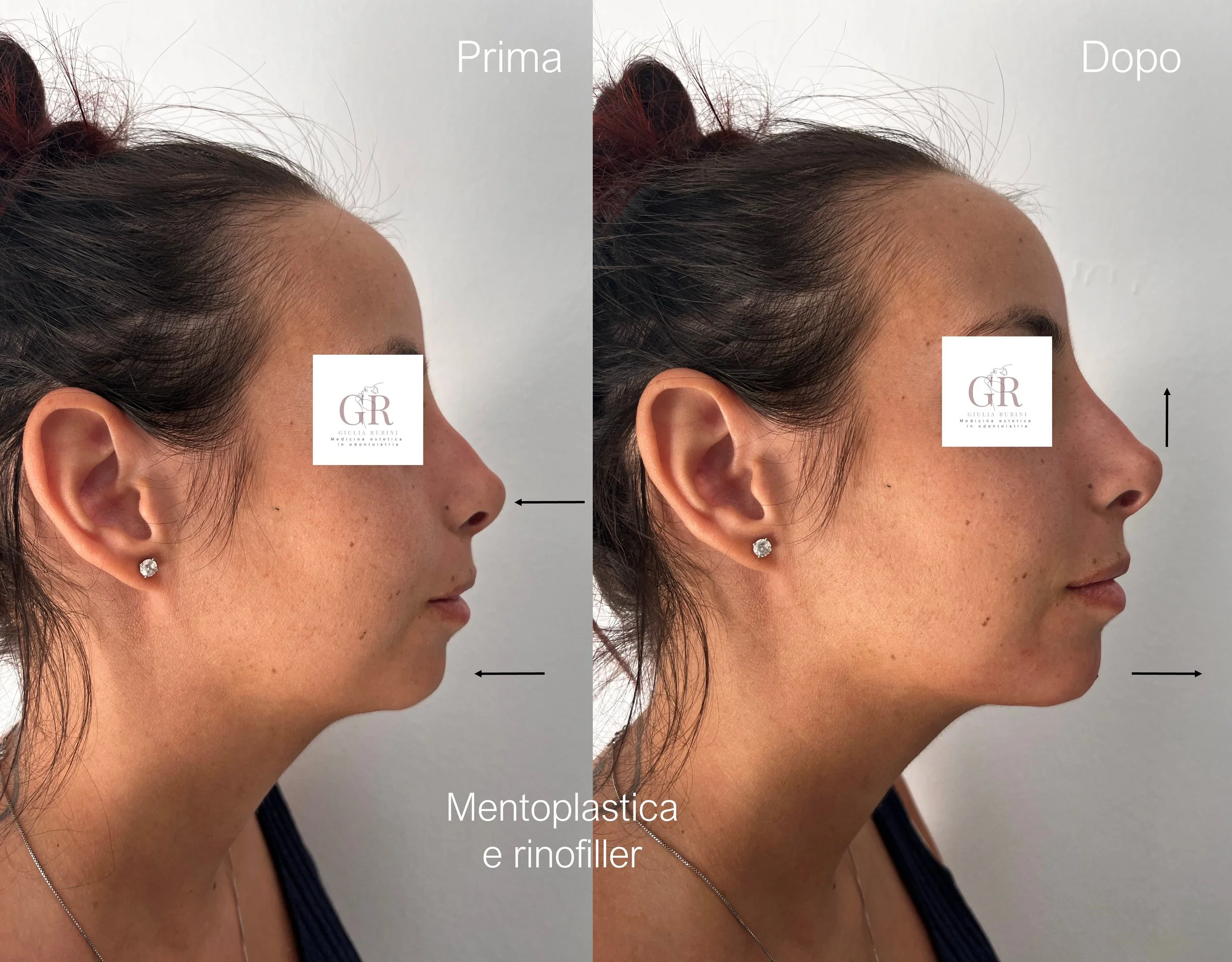Combinazione di mentoplastica e rinofiller per armonizzare mento e naso, migliorare il profilo del viso e valorizzare i lineamenti in modo naturale – Dott.ssa Giulia Rubini, medicina estetica Romagna e Marche