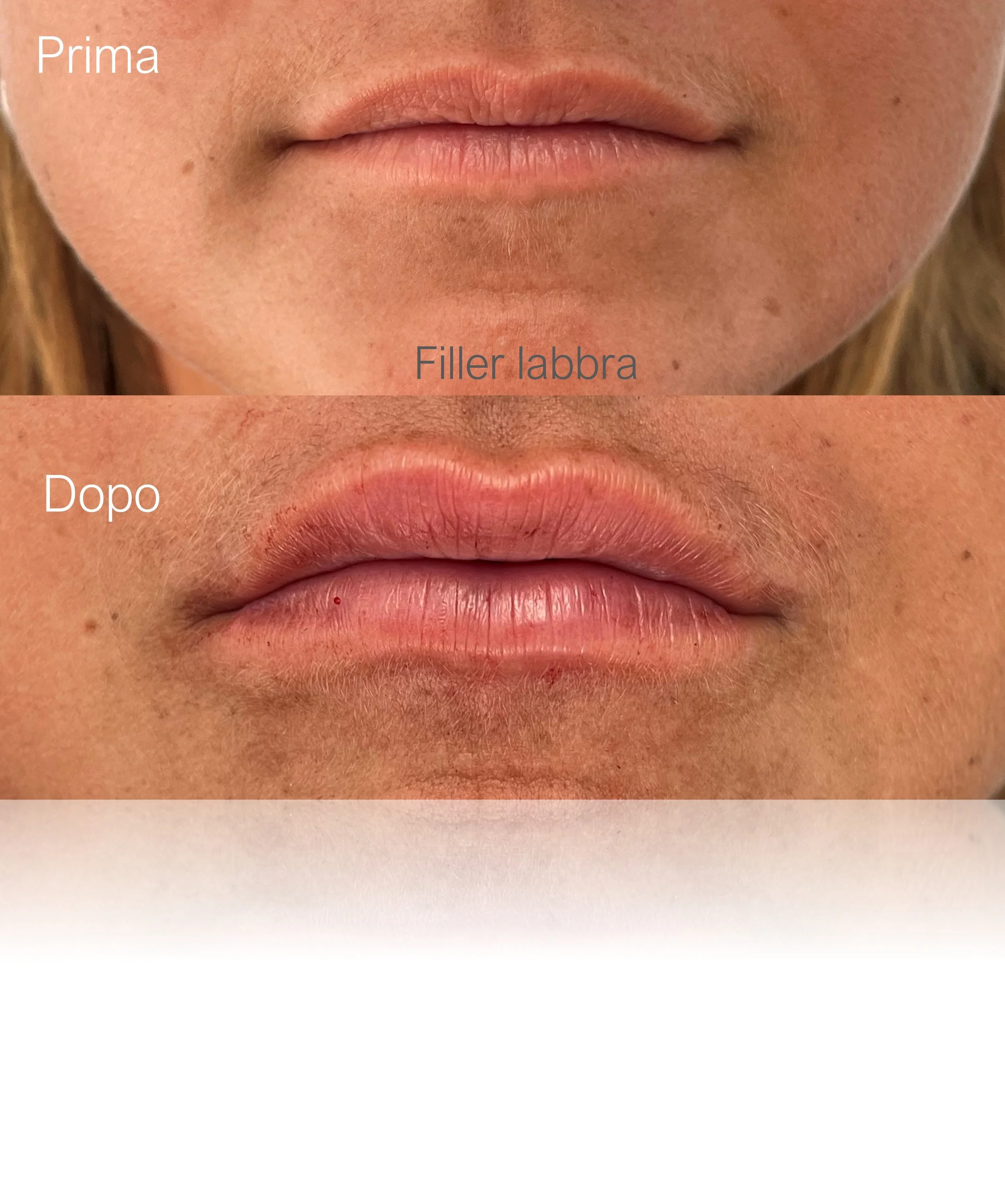 Prima e dopo filler labbra viso armonioso e naturale, trattamento estetico con la Dott.ssa Giulia Rubini in Romagna
