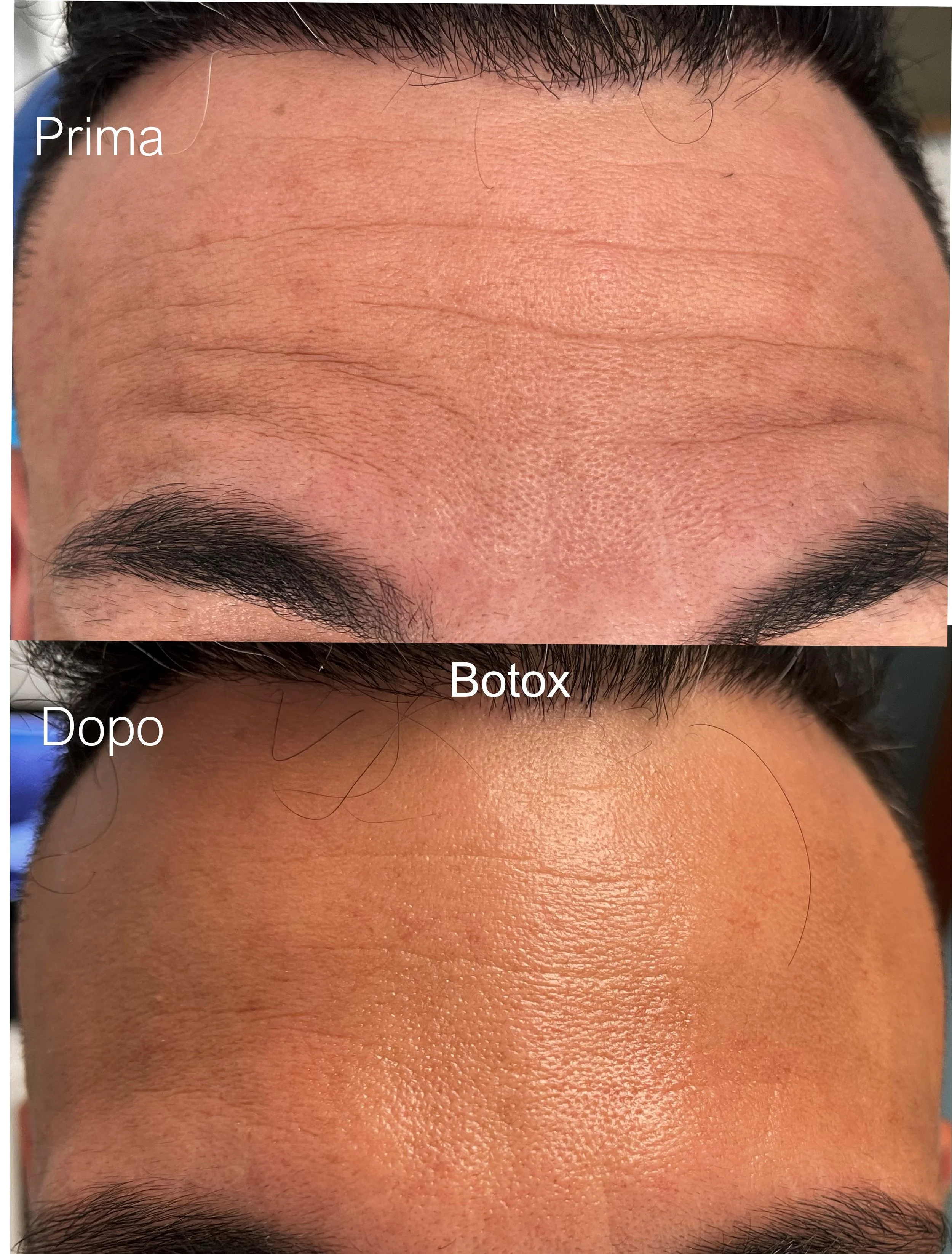 Immagine che mostra un prima e dopo di trattamenti estetici sul fronte di una persona, con una riduzione delle rughe e delle linee di espressione, evidenziando i risultati dopo l'uso di Botox.