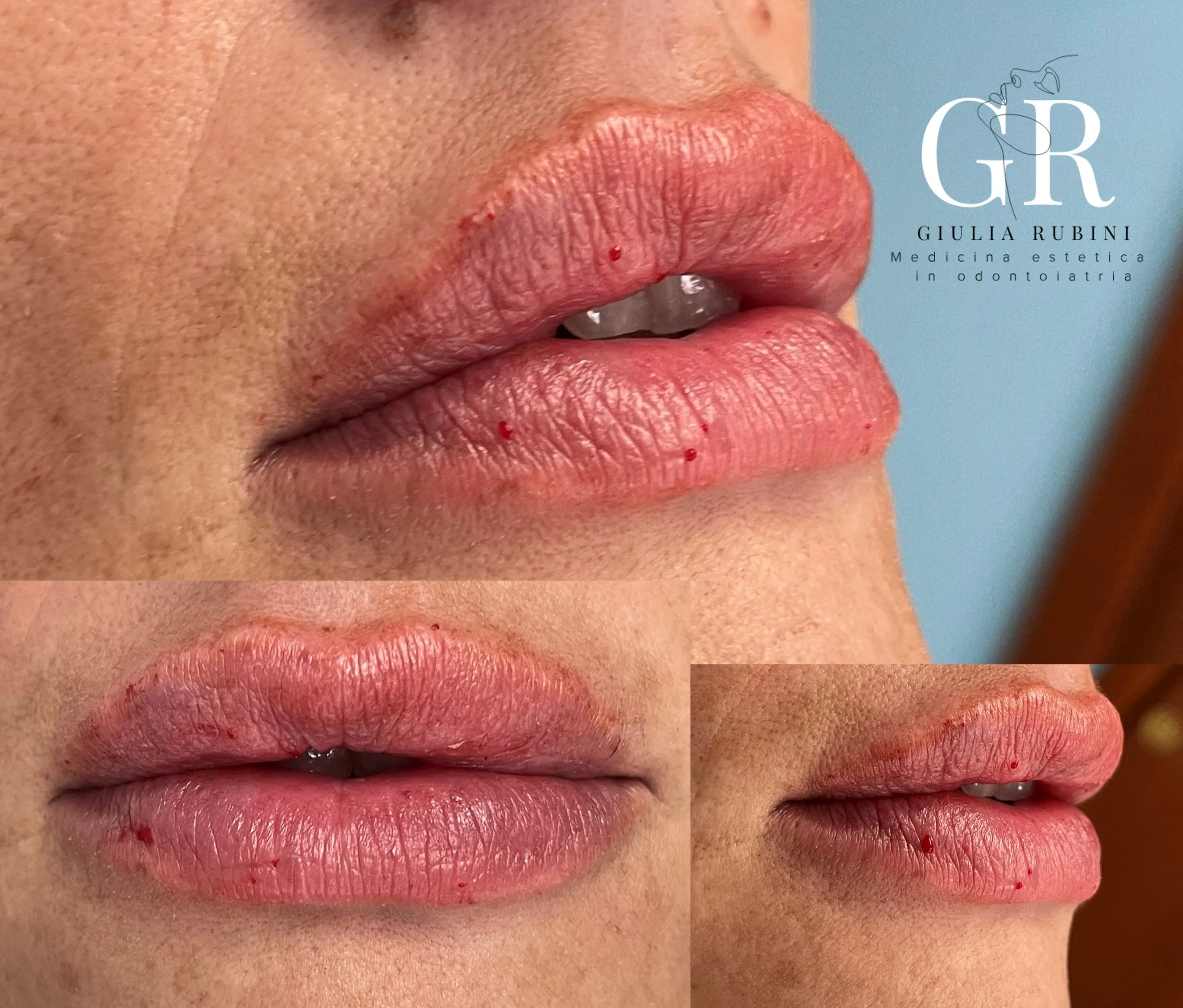 Effetto finale delle labbra di una donna dopo il trattamento di filler da parte della dott.ssa Giulia Rubini