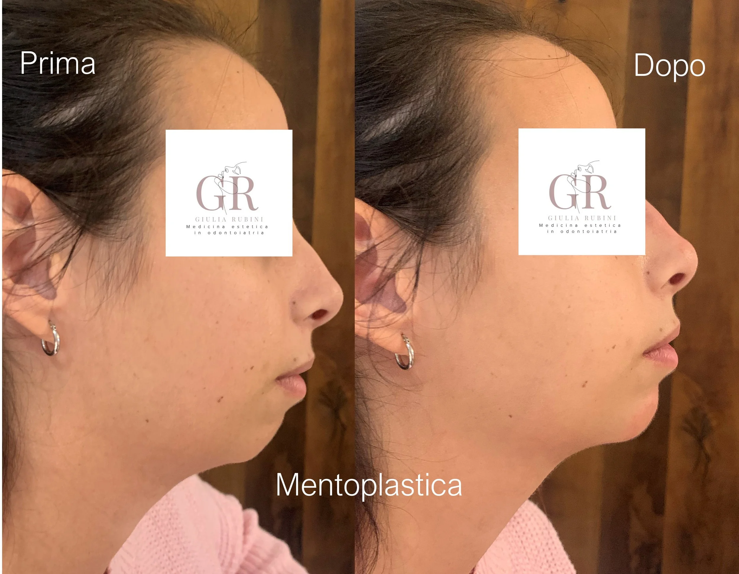 Collage prima e dopo trattamento di mentoplastica medica con la Dott.ssa Giulia Rubini, profilo del mento armonioso e naturale.